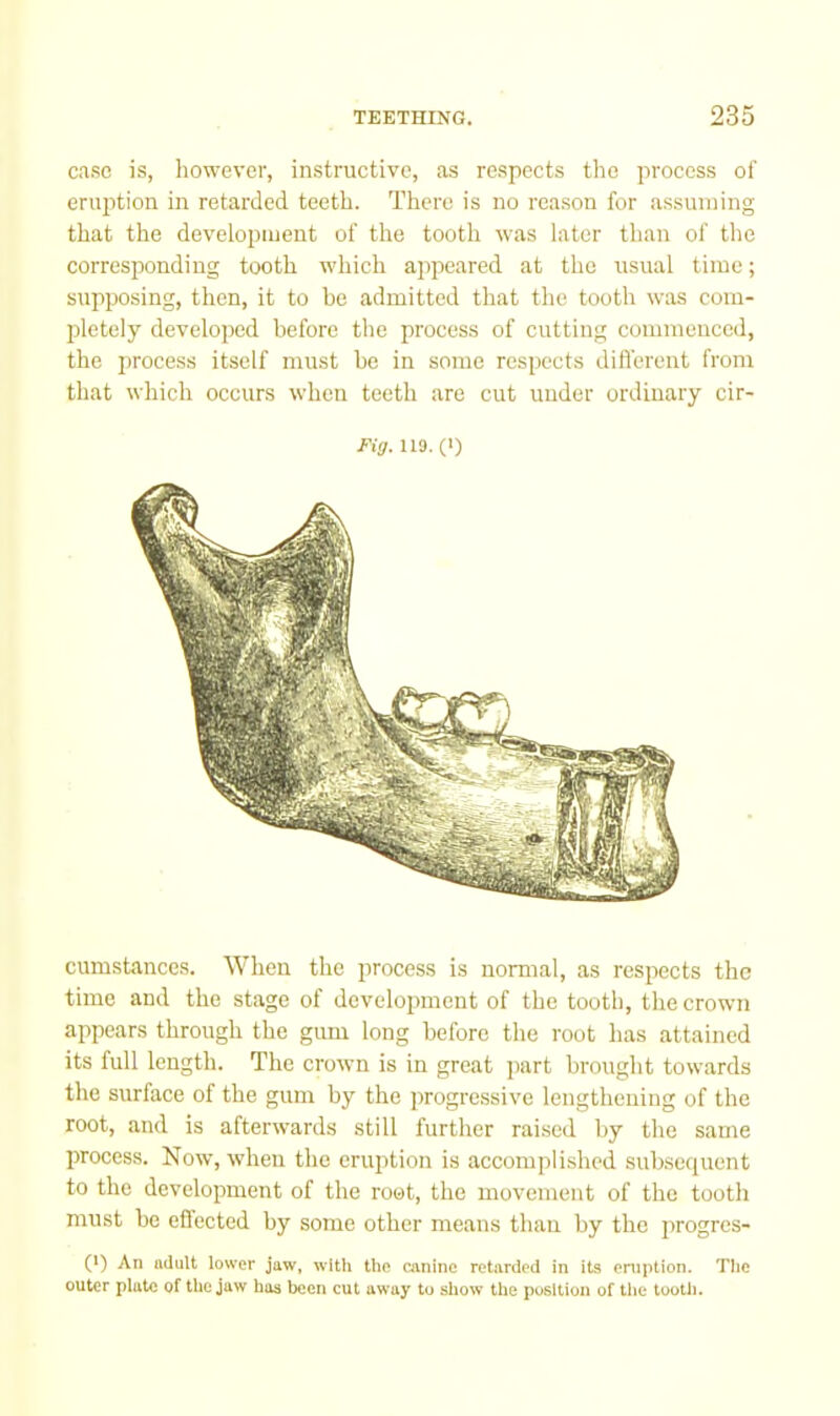 c.aso is, however, instructive, as respects the process of eruption in retarded teeth. There is no reason for assuming that the development of the tooth was later than of tlie corresponding tooth which appeared at the usual time; supposing, then, it to he admitted that tlie tooth was com- pletely developed before the process of cutting commenced, the process itself must he in some respects difl'erent from that which occurs when teeth are cut under ordinary cir- Fig. 119. (!) cumstanccs. When the process is normal, as respects the time and the stage of development of the tooth, the crown appears through the gum long before the root has attained its full length. The crown is in great part brought towards the surface of the gum by the progressive lengthening of the root, and is afterwards still further raised by the same process. Now, when the eruption is accomplished subsequent to the development of the root, the movement of the tooth must be effected by some other means than by the jirogrcs- (*) An adult lower jaw, with the canine retarded in its eruption. The outer plate of the jaw has been cut away to show the position of tlie toolli.