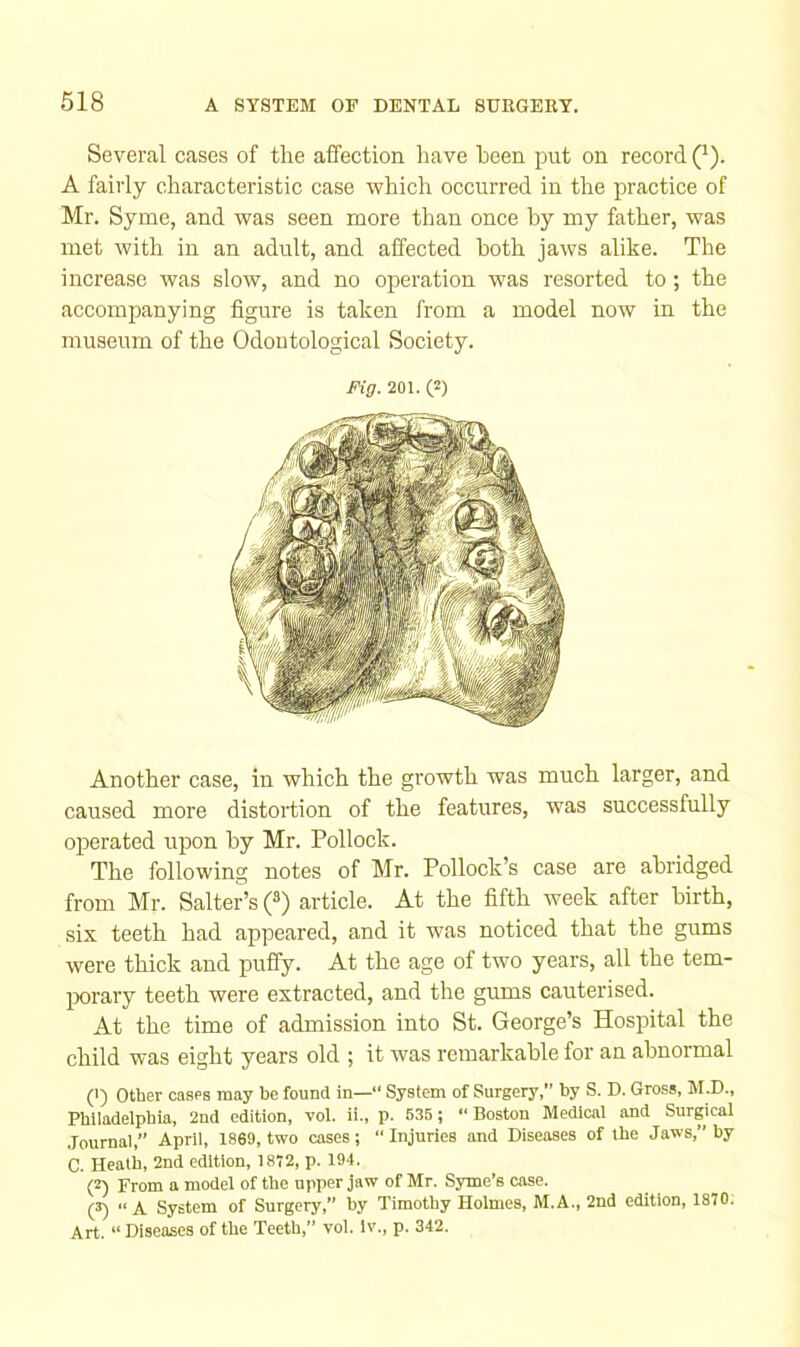 Several cases of the affection have been put on record (^). A fairly characteristic case which occurred in the practice of Mr. Syme, and was seen more than onee by my father, was met Avith in an adult, and affected both jaws alike. The increase was slow, and no operation was resorted to; the accompanying figure is taken from a model now in the museum of the Odoutological Society. Pig. 201. 0 Another case, in which the growth was much larger, and caused more distortion of the features, was successfully operated upon by Mr. Pollock. The following notes of Mr. Pollock’s case are abridged from Mr. Salter’s (») article. At the fifth week after birth, six teeth had appeared, and it was noticed that the gums were thick and puffy. At the age of two years, all the tem- jxirary teeth were extracted, and the gums cauterised. At the time of admission into St. George’s Hospital the child was eight years old ; it Avas remarkable for an abnormal (1) other cases may be found in—“ System of Surgery,” by S. D. Gross, M.D., Philadelphia, 2nd edition, vol. ii., p. 535 ;  Boston Medical and Surgical Journal,” April, 1869, two cases; “Injuries and Diseases of the Jaws,” by C. Heath, 2nd edition, 1872, p. 194. (2) From a model of the upper jaw of Mr. Syme’s case. 0 “A System of Surgery,” by Timothy Holmes, M.A., 2nd edition, 1870. Art. “ Diseases of the Teeth,” vol. Iv., p. 342.