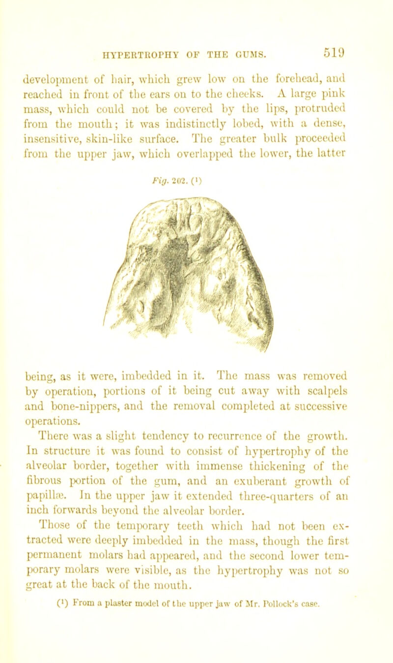 development of hair, which grew low on the forehead, and reached in front of the ears on to the cheeks. A large pink mass, which could not be covered by the lips, protruded from the mouth; it was indistinctly lobed, with a dense, insensitive, skin-like surface. The greater bulk proceeded from the upper jaw, which overlapped the lower, the latter Fig. 202. (!) being, as it were, imbedded in it. The mass was removed by operation, portions of it being cut away with scalpels and bone-nippers, and the removal completed at successive operations. There was a slight tendency to recurrence of the growth. In structure it was found to consist of hypertrophy of the alveolar border, together with immense thickening of the fibrous ixjrtion of the gum, and an exuberant growth of papillaj. In the upper jaw it extended three-quarters of an inch forwards beyond the alveolar border. Those of the temporary teeth which had not been ex- tracted were deeply imbedded in the mass, though the first permanent molars had appeared, and the second lower tem- porary molars were visible, as the hypertrophy was not so great at the back of the mouth. (>) From a plaster model of the upper jaw of Mr. Pollock’s case.