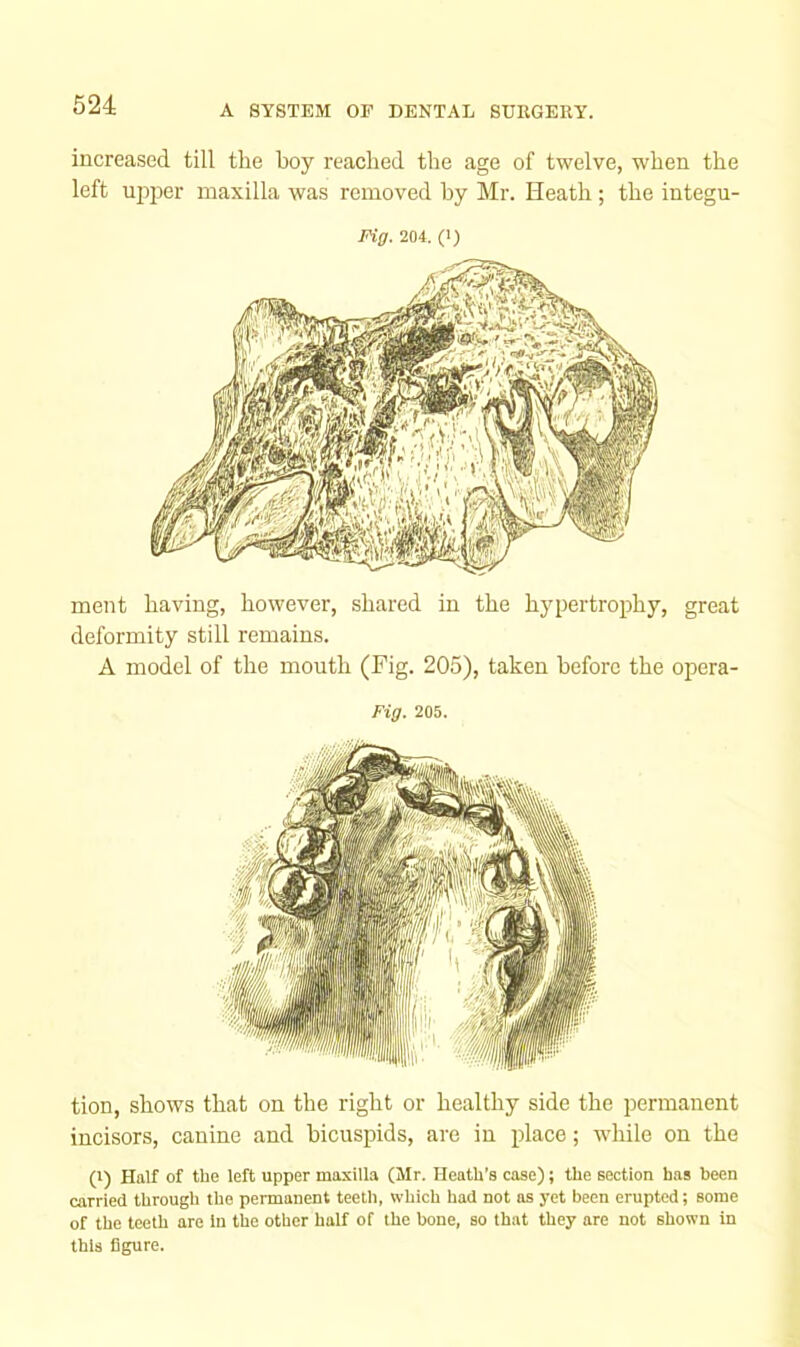 increased till the hoy reached the age of twelve, when the left ujrper maxilla wa.s removed by Mr. Heath; the integu- Fig. 204. (1) ment having, however, shared in the hypertrophy, great deformity still remains. A model of the mouth (Fig. 205), taken before the opera- Fig. 205. tion, shows that on the right or healthy side the permanent incisors, canine and bicuspids, are in place; while on the (1) Half of the left upper maxilla (Mr. Heath’s case); the section has been carried through the permanent teeth, which had not as yet been erupted; some of the teeth are in the other half of the bone, so that they are not shown in this figure.