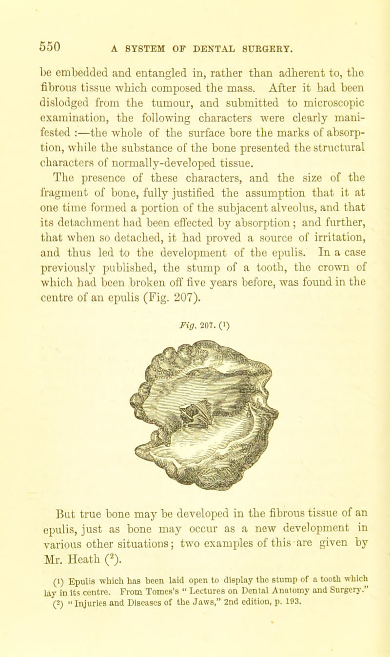 be embedded and entangled in, rather than adherent to, the fibrous tissue which composed the mass. After it had been dislodged from the tumour, and submitted to microscopic examination, the following characters were clearly mani- fested ;—the whole of the surface bore the marks of absorp- tion, while the substance of the bone presented the structural characters of normally-developed tissue. The presence of these characters, and the size of the fragment of bone, fully justified the assumption that it at one time formed a portion of the subjacent alveolus, and that its detachment had been effected by absorption; and further, that when so detached, it had proved a source of irritation, and thus led to the development of the epulis. In a case previously published, the stump of a tooth, the crown of which had been broken off five years before, was found in the centre of an epulis (Fig. 207). Fig. 207. (•) But true bone may be developed in the fibrorrs tissue of an epulis, just as bone may occur as a new development in various other situations; two examples of this are given by Mr. Heath (1) Epulis which has been laid open to display the stump of a tooth which lay in Its centre. From Tomes’s “ Lectures on Dental Anatomy and Surgery.” (2) '■ Injuries and Diseases of the Jaws,” 2nd edition, p. 193.