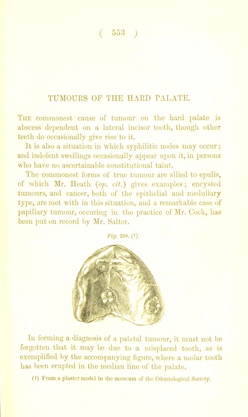 TUMOURS OF TEE HARD PALATE. The commoiie.st cause of tumour on the hard palate is abscess dependent on a lateral incisor tooth, though other teeth do occasionally give rise to it. It is also a situation in which syphilitic nodes may occur; and indolent swellings occasionally appear upon it, in persons who have no a.sccrtainable constitutional taint. The commonest forms of true tumour are allied to epulis, of which Mr. Heath {op. ctf.) gives examples; encysted tiunours, and cancer, both of the epithelial and medullary type, are met with in this situation, and a remarkable case of papillary tumour, occuring in the practice of Mr. Cock, has been put on record by IMr. Salter. Fig. 208. (1) In forming a diagnosis of a ])ahital tumour, it must not be forgotten that it may be due to a misplaced tooth, as is exemplified by the accompanying figure, where a molar tooth has been erupted in the median line of the palate. (1) From a plaster model in the museum of the Odontological Society.