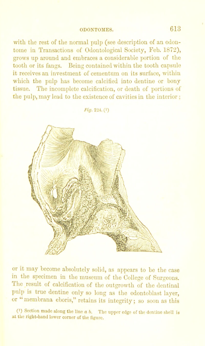 with the rest of the normal pulp (see description of an odou- tome in Transactions of Odontological Society, Feb. 1872), grows up around and embraces a considerable portion of the tooth or its fangs. Being contained within the tooth capsule it receives an investment of cementum on its surface, within which the pulp has become calcified into dentine or bony tissue. The incomplete calcification, or death of portions of tlie pulp, may lead to the existence of cavities in the interior ; Fi(j. 221. (I) or it may become absolutely solid, as appears to he the case in the specimen in the museum of the College of Surceons. The result of calcification of the outgrowth of the dentinal pulp is true dentine only so long as the odontoblast layer, or “ membrana ehoris,” retains its integrity; so soon as this (>) Section made along the line a b. The upper edge of the dentine shell is .at the right-hand lower comer of the figure.