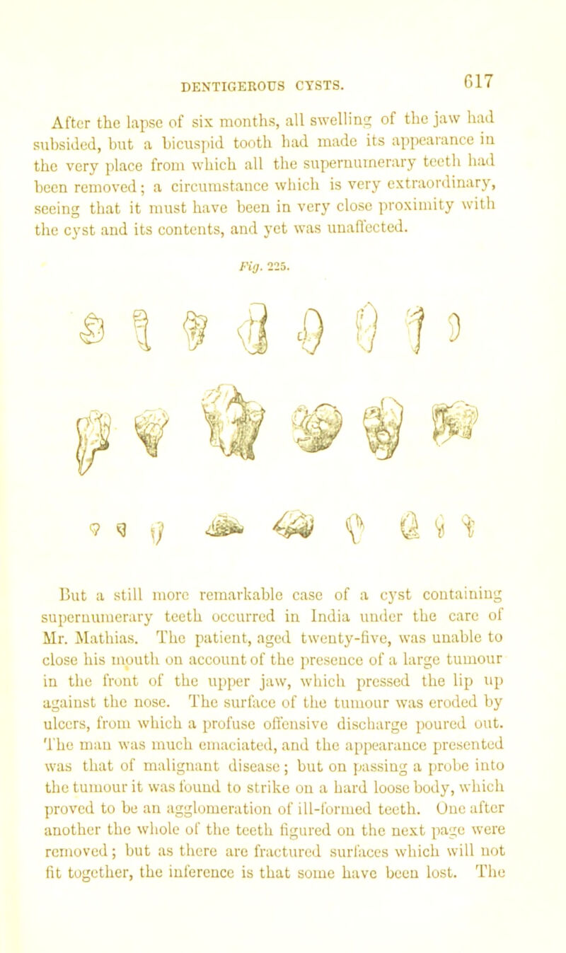 DENTIGEROUS CYSTS. G17 After the lapse of six months, all swelling of the jaw had subsided, but a bicuspid tootb had made its appearance in the very place from which all the supernumerary teeth had been removed; a circumstance which is very extraordinary, seeing that it must have been in very close proximity with the cyst and its contents, and yet was unaflected. But a still more remarkable case of a cyst containing supernumerary teeth occurred in India under the care of Mr. Mathias. The patient, aged twenty-five, was unable to close his mouth on account of the presence of a large tumour in the front of the upper jaw, which pressed the lip up against the nose. The surface of the tumour was eroded by ulcers, from which a profuse offensive discharge poured out. The man was much emaciated, and the appearance presented was that of malignant disease; but on passing a probe into the tumour it was found to strike on a hard loose body, which proved to be an agglomeration of ill-formed teeth. One after another the whole of the teeth figured on the next page were removed; but as there are fractured surfaces which will not fit together, the inference is that some have been lost. The Pig. 225.