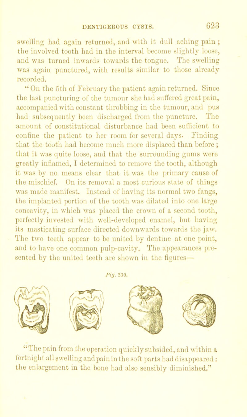 G23 swelling had again returned, and with it dull aching pain ; the involved tooth had in the interval become slightly loose, and was turned inwards towards the tongue. The swelling was again punctured, with results similar to those already recorded. “ On the 5tli of February the patient again returned. Since the last puncturing of the tumour she had sufl’ered great pain, accompanied with constant throbbing in the tumour, and pus had subsequently been discharged from the puncture. The amount of constitutional disturbance had been sullicient to confine the patient to her room for several days. Finding that the tooth had become much mure displaced than before ; that it was (piite loose, and that the surrounding gums were greatly inflamed, 1 determined to remove the tooth, although it was by no means clear tliat it was the primary cause of the mischief. On its removal a most curious state of things was maile manifest. Instead of having its normal two fangs, the imjilanted iwrtion of the tooth was dilated into one large concavity, in which was placed the crown of a second tooth, jierfectly invested with well-ileveloped enamel, hut having its masticating surface directed downwards towards the jaw. The two teeth appear to be united by dentine at one point, and to have one common pulp-cavity. The appearances pre- sented by the united teeth are shown in the figures— ng. 230. “The pain from the operation (juickly subsided, and within a fortnight all swelling and j)aininthe soft parts haddisap])earcd : the enlargement in the bone had also sensibly diminished.”