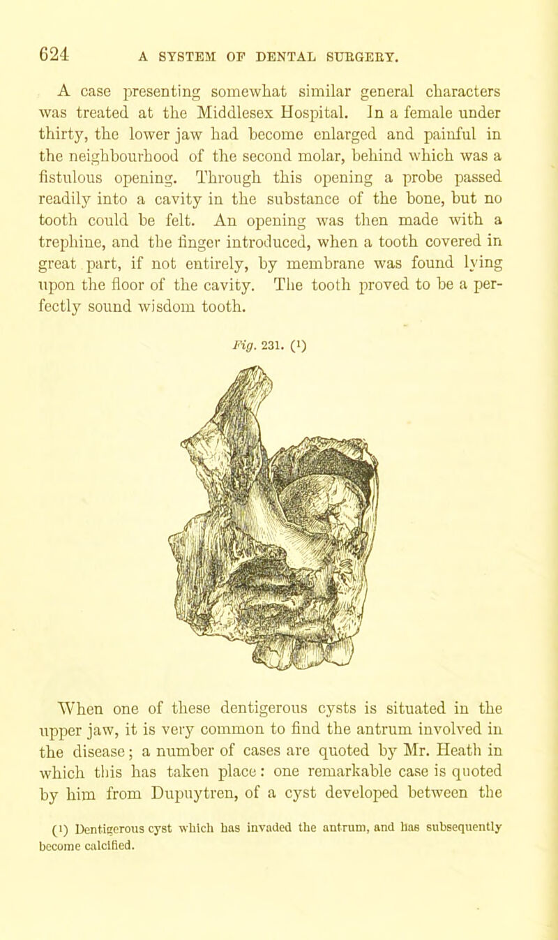 A case presenting somewhat similar general characters was treated at the Middlesex Hospital. In a female under thirty, the lower jaw had become enlarged and painful in the neighbourhood of the second molar, behind which was a fistulous opening. Through this opening a probe X3assed readily into a cavity in the substance of the bone, but no tooth could be felt. An opening was then made with a trephine, and the finger introduced, when a tooth covered in great part, if not entirely, by membrane was found lying upon the floor of the cavity. The tooth proved to be a per- fectly sound wisdom tooth. Fig. 231. (1) When one of these dentigerous cysts is situated in the upper jaw, it is very common to find the antrum involved in the disease; a number of cases are quoted by Mr. Heatli in which this has taken place: one remarkable case is quoted by him from Dupuytren, of a cyst developed between the (I) Denti!;erous cyst which has invaded the antrum, and has subsequently become calcified.