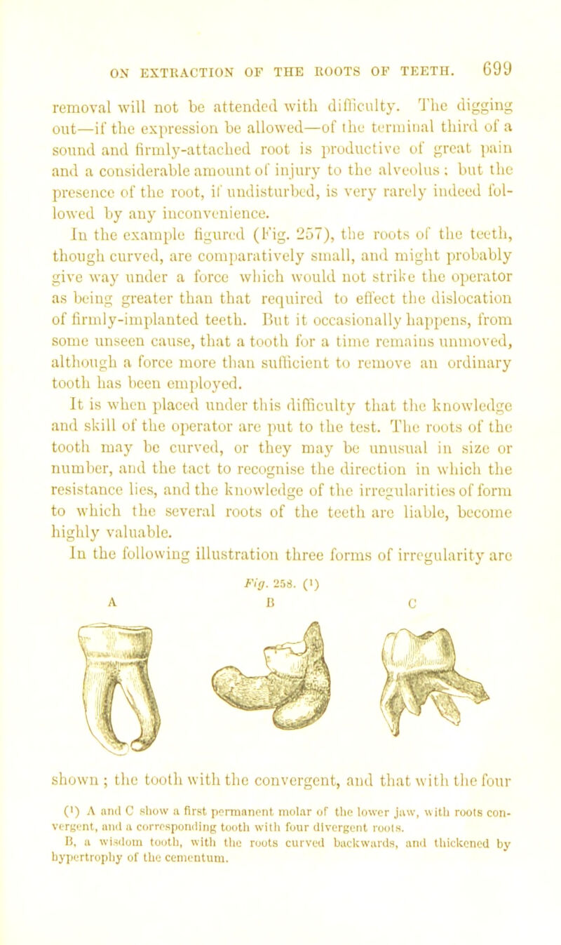 removal will not be attended with difficulty. 'I’lie digging out—it'the expression he allowed—of the tenuitial third of a sound and firmly-attached root is productive of great ]iaiu and a considerable amount of injury to the alveolus; but the presence of the root, if undisturbed, is very rarely indeed fol- lowed by any inconvenience. In the example figured (Fig. 257), the roots of the teeth, though curved, are comparatively small, and might probably give way under a force which would not strike the operator as being greater than that required to effect the dislocation of firmly-implanted teeth. But it occasionally happens, from some unseen cause, that a tooth for a time remains unmoved, although a force more than sufficient to remove an ordinary tooth has been employed. It is when placed under this difficulty that the knowledge and skill of the operator are put to the test. The roots of the tooth may be curved, or they may be unusual in size or number, and the tact to recognise the direction in which the resistance lies, and the knowledge of the irregularities of form to which the several roots of the teeth are liable, become highly valuable. In the following illustration three forms of irregularity are Fig. 258. (1) A Be shown; the tooth with the convergent, and that with the four (•) A and C show a first permanent molar of the lower jaw, with roots con« vergent, and a corresponding tooth with four divergent roots. H, a wi.sdom tooth, with tlie roots curved backwards, and thickened by hyjiertrophy of the cemeutum.