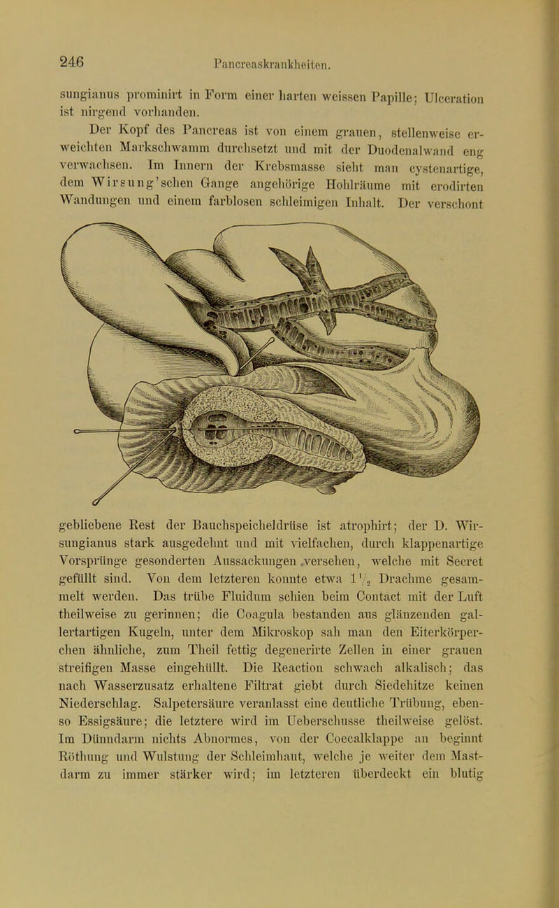 suiigiaiuis proniinirt in Form einer harten weissen Papille; Uiceration ist nirgend vorhanden. Der Kopf des Pancreas ist von einem grauen, stellenweise er- weichten Markschwanim durchsetzt und mit der Duodenalwand eng verwachsen. Im Innern der Krebsmasse sieht man cystenartige, dem Wirsung'sehen Gange angehörige Hoiilräume mit erodirten Wandungen und einem farblosen schleimigen Inhalt. Der verschont gebliebene Rest der Bauchspeicheldrüse ist atrophirt; der D. Wir- simgianus stark ausgedehnt und mit vielfachen, durch klappenartige Vorsprünge gesonderten Aussackungen .versehen, welche mit Secret gefüllt sind. Von dem letzteren konnte etwa 1' 2 Drachme gesam- melt werden. Das trübe Fluidum schien beim Contact mit der Luft theilweise zu gerinnen; die Coagula bestanden aus glänzenden gal- lertartigen Kugeln, imter dem Milu'oskop sah man den Eiterkörper- chen ähnliche, zum Theil fettig degenerirte Zellen in einer grauen streifigen Masse eingehüllt. Die Reaction schwach alkalisch; das nach Wasserzusatz erhaltene Filtrat giebt durch Siedehitze keinen Niederschlag. Salpetersäure veranlasst eine deutliehe Trübung, eben- so Essigsäure; die letztere wird im Ueberschusse theilweise gelöst. Im Dünndarm nichts Abnormes, von der Coecalklappe an beginnt Rüthung und Wulstung der Schleimhaut, welche je weiter dem Mast- darm zu immer stärker wird; im letzteren überdeckt ein blutig