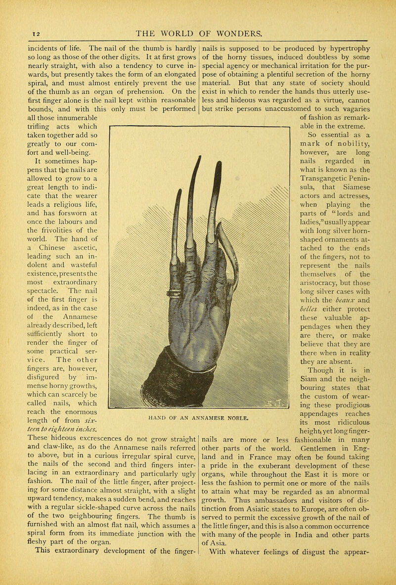 incidents of life. The nail of the thumb is hardly so long as those of the other digits. It at first grows nearly straight, with also a tendency to curve in- wards, but presently takes the form of an elongated spiral, and must almost entirely prevent the use of the thumb as an organ of prehension. On the first finger alone is the nail kept within reasonable bounds, and with this only must be performed all those innumerable trifling acts which taken together add so greatly to our com- fort and well-being. It sometimes hap- pens that t]je nails are allowed to grow to a great length to indi- cate that the wearer leads a religious life, and has forsworn at once the labours and the frivolities of the world. The hand of a Chinese ascetic, leading such an in- dolent and wasteful existence, presents the most extraordinary spectacle. The nail ©f the first finger is indeed, as in the case of the Annamese already described, left sufficiently short to render the finger of some practical ser- vice. The other fingers are, however, disfigured by im- mense horny growths, which can scarcely be called nails, which reach the enormous length of from six- ieeti to ei^hteeti inches. These hideous excrescences do not grow straight and claw-like, as do the Annamese nails referred to above, but in a curious irregular spiral curve, the nails of the second and third fingers inter- lacing in an extraordinary and particularly ugly fashion. The nail of the little finger, after project- ing for some distance almost straight, with a slight upward tendency, makes a sudden bend, and reaches with a regular sickle-shaped curve across the nails of the two ijeighbouring fingers. The thumb is furnished with an almost flat nail, which assumes a spiral form from its immediate junction with the fleshy part of the organ. This extraordinary development of the finger- HAND OF AN ANNAMESE NOBLE. nails is supposed to be produced by hypertrophy of the horny tissues, induced doubtless by some special agency or mechanical irritation for the pur- pose of obtaining a plentiful secretion of the horny- material. But that any state of society should exist in which to render the hands thus utterly use- less and hideous was regarded as a virtue, cannot but strike persons unaccustomed to such vagaries of fashion as remark- able in the extreme. So essential as a mark of nobility, however, are long nails regarded in what is known as the Transgangetic Penin- sula, that Siamese actors and actresses, when playing the parts of lords and ladies, usually appear with long silver horn- shaped ornaments at- tached to the ends of the fingers, not to represent the nails themselves of the aristocracy, but those long silver cases with which the beaux and belles either protect these valuable ap- pendages when they are there, or make believe that they are there when in reality^ they are absent. Though it is in Siam and the neigh- bouring states that the custom of wear- ing these prodigious, appendages reaches its most ridiculous height; yet long finger- fashionable in many Gentlemen in Eng- nails are more or less other parts of the world, land and in France may often be found taking a pride in the exuberant development of these organs, while throughout the East it is more or less the fashion to permit one or more of the nails to attain what may be regarded as an abnormal growth. Thus ambassadors and visitors of dis- tinction from Asiatic states to Europe, are often ob- served to permit the excessive growth of the nail of the little finger, and this is also a common occurrence with many of the people in India and other parts, of Asia. With whatever feelings of disgust the appear-