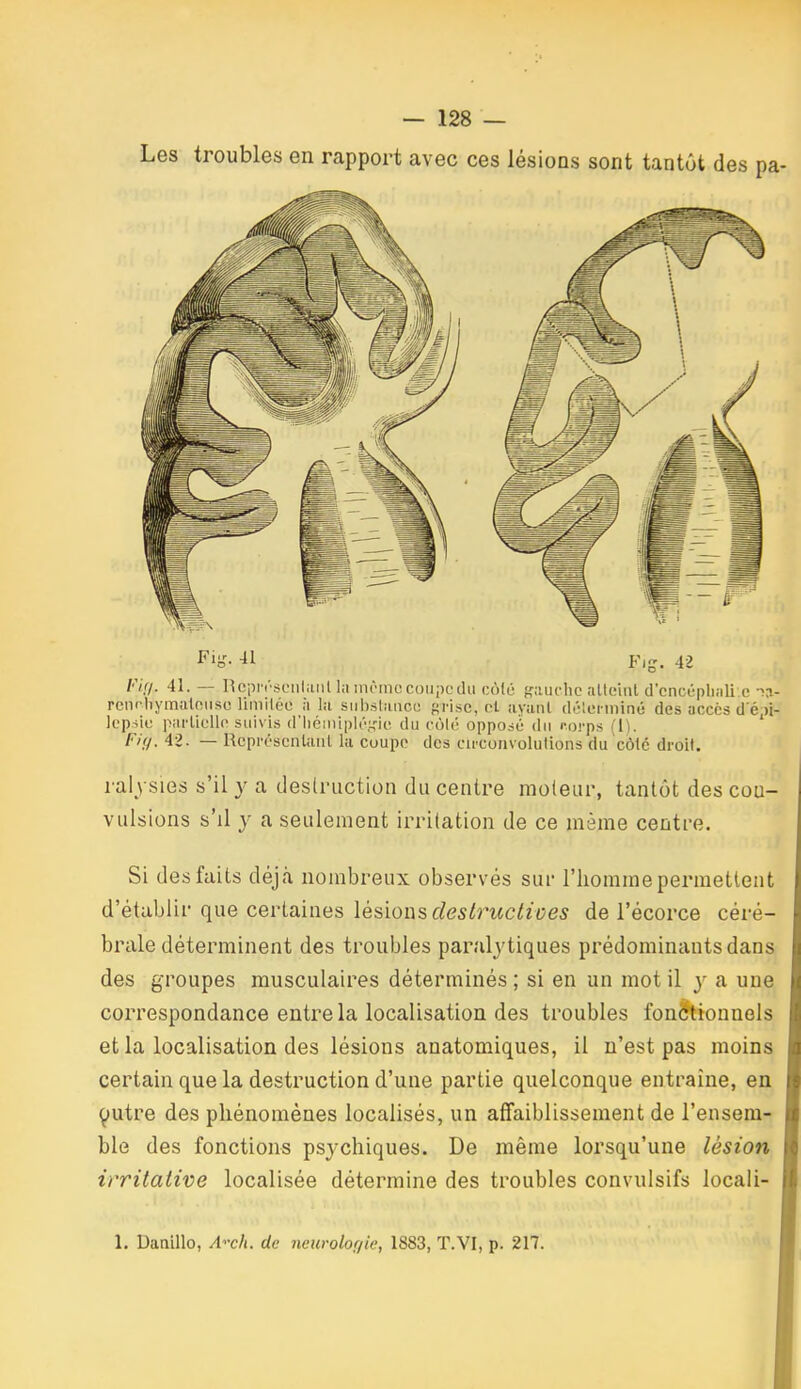 Les troubles en rapport avec ces lésions sont tantôt des pa- Fi- 41 Fig. 42 Fi;/. 41. — Rcpi rsciiliuilhitiu'mocoiipcdu côte giiuchc alteinl d'cncépluill c 13- rciK-liymaloiiso hmilee ii la siibsliincc; ffi-ise, cl ayant (I.jlerininé des accès d e.)i- Icp-iie pai'liello suivis d'iiéiniplr-ic, du vùU': opposé du roi'ps (l). Fi;/. 42. — Rcpi'éscnlaut la cuupp des cu'Convolulions du côte droit. ralysies s'il y a destruction du centre moteur, tantôt des con- vulsions s'il y a seulement irritation de ce même centi'e. Si des faits déjà nombreux observés sur l'homme permettent d'établir que certaines lésions deslructioes de l'écorce céré- brale déterminent des troubles paralytiques prédominants dans des groupes musculaires déterminés ; si en un mot il y a une correspondance entre la localisation des troubles fonctionnels et la localisation des lésions anatomiques, il n'est pas moins certain que la destruction d'une partie quelconque entraîne, en 9utre des phénomènes localisés, un affaiblissement de l'ensem- ble des fonctions psychiques. De même lorsqu'une lésion irritative localisée détermine des troubles convulsifs locali- 1. Daaillo, A-'ck. de neuroloffie, 1883, T.VI, p. 217.