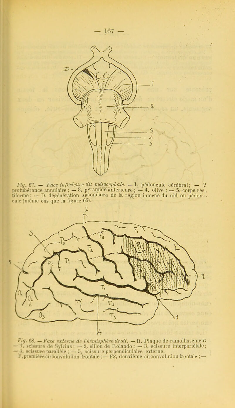 Fig. 67. — Face inférieure du mésocéphale. — 1, pédoncule cérébral; — 2 protubérance annulaire; —3, pyramide antérieure ; — 4, olive ; — 5, corps res, tiforme : — D. dégénération secondaire de la région interne du nid ou pédon-- cule (même cas que la figure 66). Fi(j. 08. — Fane externe de L'lirimisphère droit. — 11. Plaque de ramolllssoment - 1, acisHUPf! de Sylvius; —2, sillon de Rolando ; — 3, scissure inlerpariétale; -4, scissure paralféle ;— 5, scissure perpendiculaire externe. F, première circonvolution frontale; — V2, deuxième circonvolution frontale ; —