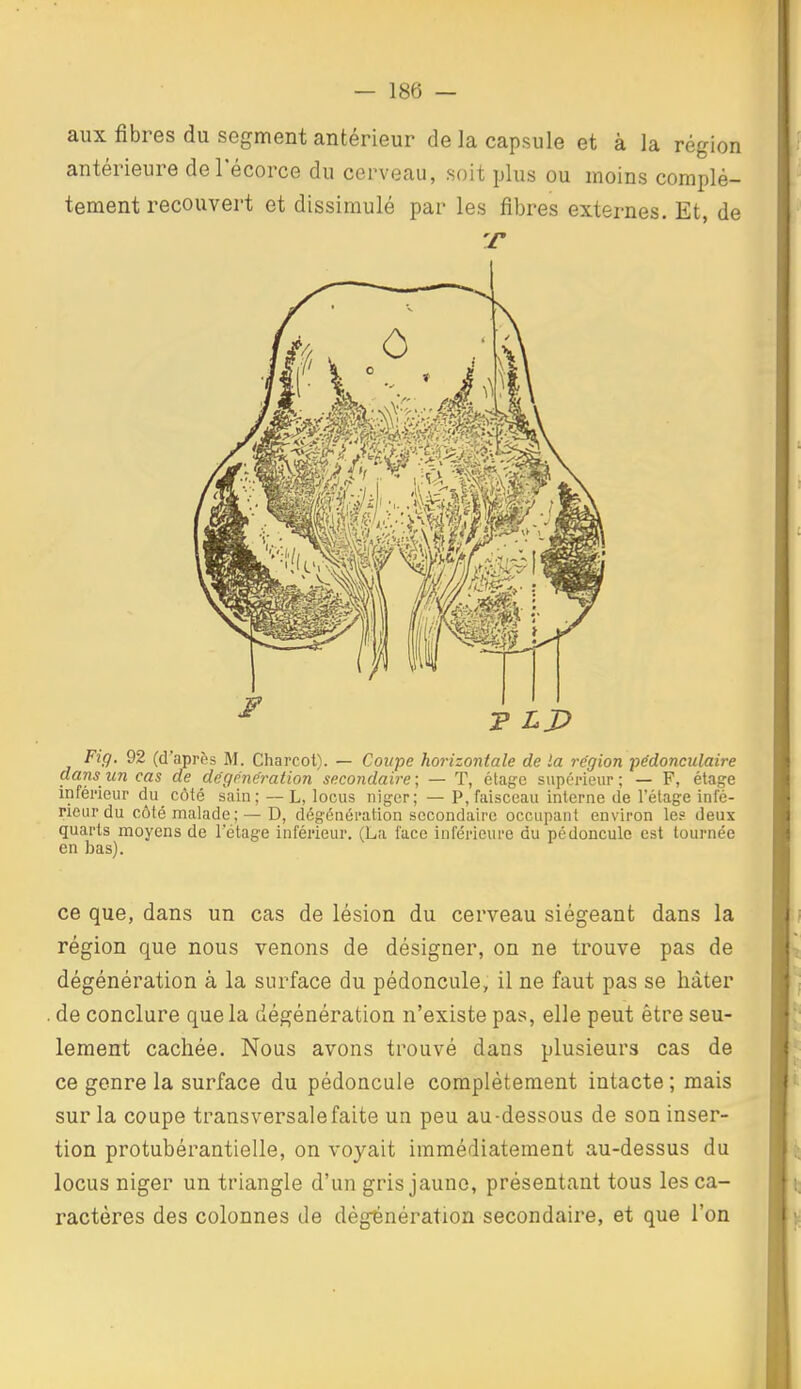 aux fibres du segment antérieur de la capsule et à la région antérieure deTécorce du cerveau, soit plus ou moins complè- tement recouvert et dissimulé par les fibres externes. Et, de Fig. 92 (d'après M. Charcot). — Coupe horizontale de la région pédonculaire dans un cas de dégénération secondaire; — T, éta^e supérieur; — F, étage inférieur du côté sain; — L, locus iiiger; — P, faisceau interne de l'étage infé- rieur du côté malade; — D, dégénération secondaire occupant environ les deux quarts moyens de l'étage inférieur. (La face inférieure du pédoncule est tournée en bas). ce que, dans un cas de lésion du cerveau siégeant dans la région que nous venons de désigner, on ne trouve pas de dégénération à la surface du pédoncule, il ne faut pas se hâter . de conclure que la dégénération n'existe pas, elle peut être seu- lement cachée. Nous avons ti^ouvé dans plusieurs cas de ce genre la surface du pédoncule complètement intacte ; mais sur la coupe transversale faite un peu au-dessous de son inser- tion protubérantielle, on voyait immédiatement au-dessus du locus niger un triangle d'un gris jaune, présentant tous les ca- ractères des colonnes de dégénération secondaire, et que l'on