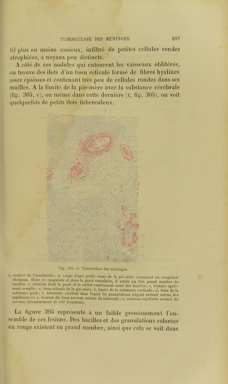 tir plus OU moins caséeux, infiltré de petites cellules rondes atrophiées, à noyaux peu distincts. A côté de ces nodules qui entourent les vaisseaux oblitérés, ou trouve des îlots d'un tissu réticulé formé de fibres hyalines assez épaisses et contenant très peu de cellules rondes dans ses mailles. A la limite de la pie-mère avec la substance cérébrale (fig. 305, v), ou même dans cette dernière {t, fig. 305), on voit quelquefois de petits îlots tuberculeux. Fig. aOo. — Tuberculose des méninges. S surface de l'araclinoulc; a, coupe d'une petite veine de la pie-mère contenant un coagulum .Ijrineux. Dans ce coagulum et dans la paroi vasculaire, il existe un très grand nombre do hacdics. u arter.olc dont la paroi et le caillot contiennent aussi des bacilles; c, veinule égale- ment remplie; r, tissu réticule do la pie-mère; b, limite de la substance corticale ; </. tissu de la substance grise ; tubercule cérébral dans lequel les granulations siègent surtout autour des capillaires m ; s, lacunes du tissu nerveux autour du tubercule;», vaisseau capillaire normal du cerveau (Grossissement de 100 diamètres). La figure 305 représente à un faible grossissement l'en- semble de ces lésions. Des bacilles et des granulations colorées en rouge existent en grand nombre, ainsi ([ue cela se voit dans