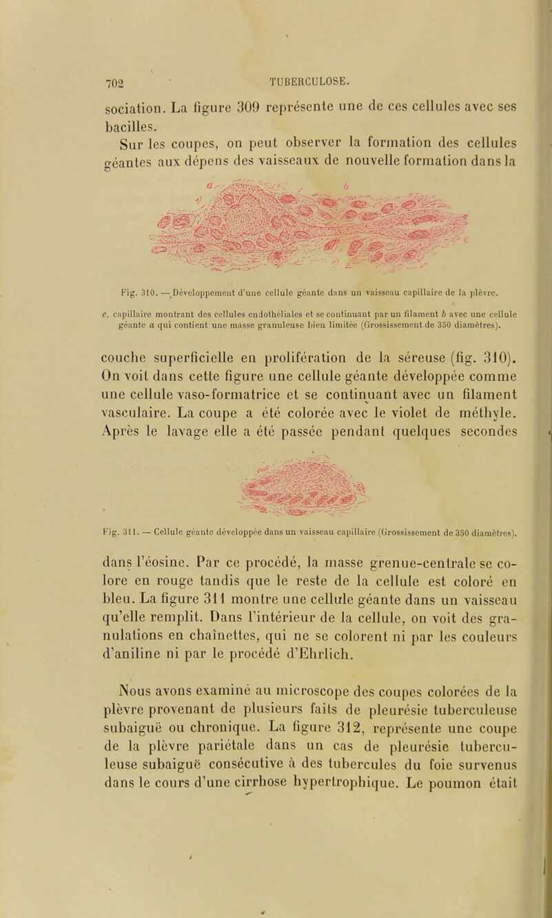 sociation. La figure 309 représente une de ces cellules avec ses bacilles. Sur les coupes, on peut observer la formation des cellules géantes aux dépens des vaisseaux de nouvelle formation dans la Fig. 310. —^Développement d'une cellule goautc dans un vaisseau capillaire de la plèvre. c, capillaire montrant des cellules endothéliales et se continuant par un filament b avec une cellule géante a qui contient une masse granuleuse bien limitée (Grossissement de 3o0 diamètres). couche superficielle en prolifération de la séreuse (fig. 310). On voit dans cette figure une cellule géante développée comme une cellule vaso-formatrice et se continuant avec un filament vasculaire. La coupe a été colorée avec le violet de méthyle. Après le lavage elle a été passée pendant quelques secondes Fig. 311. — Cellule géante développée dans un vaisseau capillaire (Grossissement de 350 diamètres). dans réosine. Par ce procédé, la masse grenue-centrale se co- lore en rouge tandis que le reste de la cellule est coloré en bleu. La figure 3H montre une cellule géante dans un vaisseau qu'elle remplit. Dans l'intérieur de la cellule, on voit des gra- nulations en chaînettes, qui ne se colorent ni par les couleurs d'aniline ni par le procédé d'Ehrlich. Nous avons examiné au microscope des coupes colorées de la plèvre provenant de plusieurs faits de pleurésie tuberculeuse subaiguë ou chronique. La figure 312, représente une coupe de la plèvre pariétale dans un cas de pleurésie tubercu- leuse subaiguë consécutive à des tubercules du foie survenus dans le cours d'une cirrhose hyperlrophique. Le poumon était