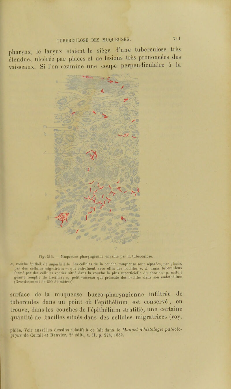 pharynx, le larynx étaient le siège d'une tuberculose très étendue, ulcérée par places et de lésions très prononcées des vaisseaux. Si l'on examine une coupe perpendiculaire à la ''••A> ,, ... •iji. / \\\ 7 Fig. 313. — Muqueuse pharyngienne envahie par la tuberculose. a, Ciiûche cpilhélinle superficielle ; les cellules de la couche muqueuse sont séparées, par pinces, par des cellules migratrices m qui entraînent avec elles des bacilles c. /i, amas tuberculeux formé par des cellules rondes situé dans la couche la plus superficielle du chorion ; ff, cellule géante remplie de bacilles; i', petit vaisseau qui présente des bacilles-dans sou eudothéliuni (Grossissement de 500 di.imèlros). surface de la muqueuse bucco-pharyngiennc infiltrée de tubercules dans un point où l'épithélium est couservé , on trouve, dans les couches de l'épilhélium stratiiié, une certaine quantité de bacilles situés dans des cellules migratrices (voy. phiée. Voir aussi lus dessins relatifs ii co fait dans le Manuel d'histologie palholo-