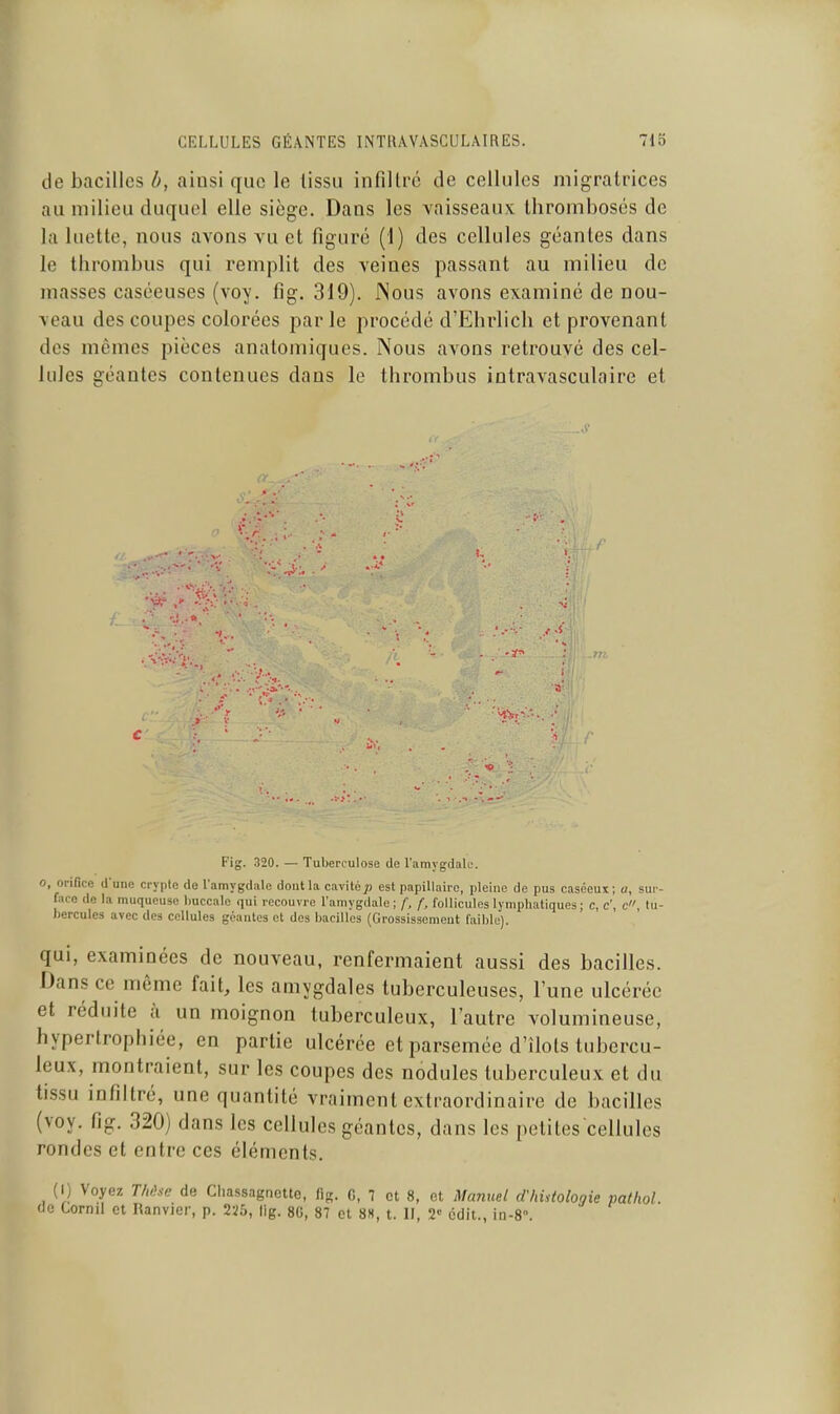 de bacilles b, ainsi que le tissu infillrc de cellules migratrices au milieu duquel elle siège. Dans les vaisseaux, thromboses de la luette, nous avons vu et figuré (1) des cellules géantes dans le thrombus qui remplit des veines passant au milieu de masses caséeuses (voy. fig, 319). Nous avons examiné de nou- veau des coupes colorées par le procédé d'Ehrlich et provenant des mêmes pièces anatomiques. Nous avons retrouvé des cel- lules géantes contenues dans le thrombus intravasculaire et c Fig. 320. — Tuberculose de l'amygdale. 0 onlice d'une crypte de l'amygdale dont la cavitép est papillaire, pleine de pus caséeux ; o, sur- face de la muqueuse buccale qui recouvre l'amygdale; /■, f, follicules lymphatiques; c, c', c, tu- bercules avec des cellules géantes et des bacilles (Grossissement faible). qui, examinées de nouveau, renfermaient aussi des bacilles. Dans ce même fait, les amygdales tuberculeuses, l'une ulcérée et réduite à un moignon tuberculeux, l'autre volumineuse, hypertrophiée, en partie ulcérée et parsemée d'îlots tubercu- leux, montraient, sur les coupes des nodules tuberculeux et du tissu infiltré, une quantité vraiment extraordinaire de bacilles (voy. fig. 320) dans les cellules géantes, dans les petites cellules rondes et entre ces éléments. (I) Voyez TluUe de Cliassagnetto, fig. C, 1 et 8, et Manuel d'histologie pathol. de Cornil et Ranvier, p. 226, lig. 80, 87 et 8S, t. II, 2« cdit., in-8°.