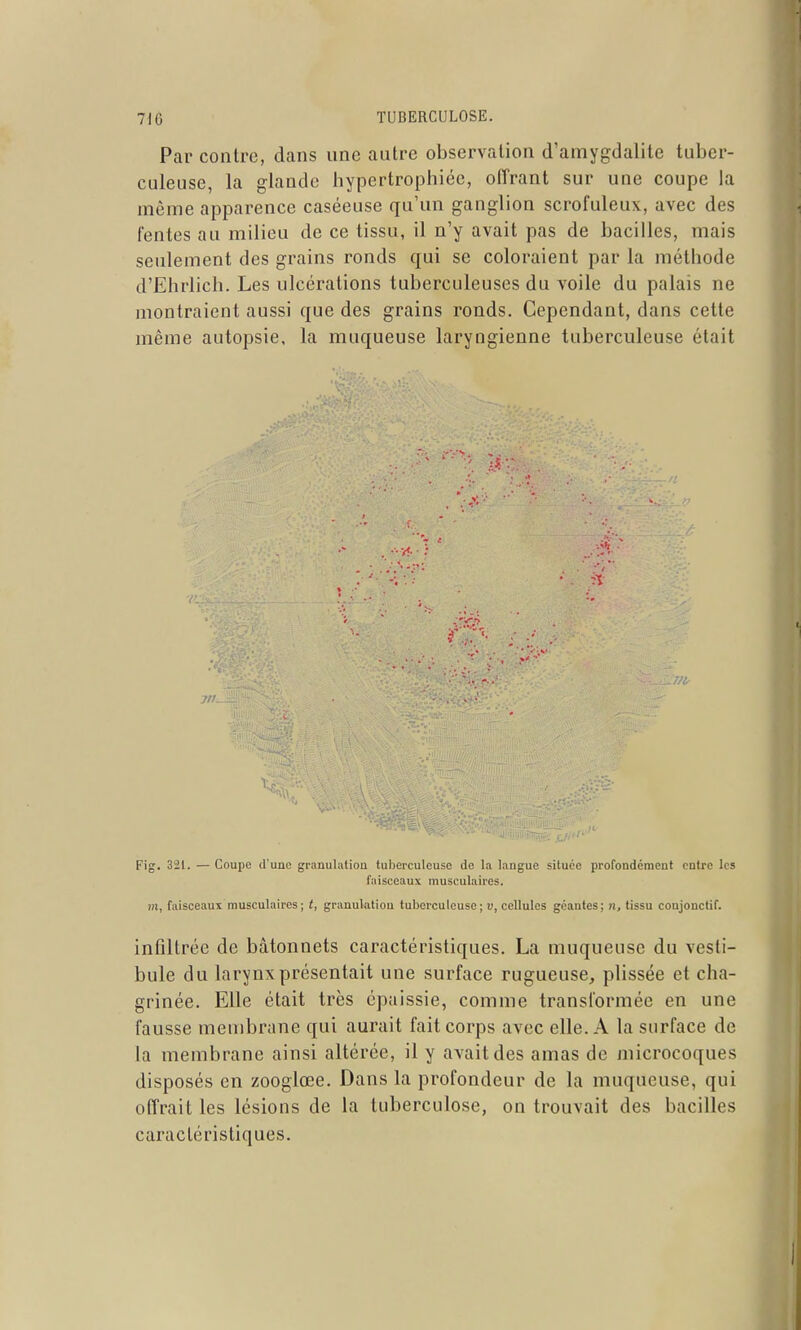 Par contre, dans une autre observation d'amygdalite tuber- culeuse, la glande hypertrophiée, offrant sur une coupe la même apparence caséeuse qu'un ganglion scrofuleux, avec des fentes au milieu de ce tissu, il n'y avait pas de bacilles, mais seulement des grains ronds qui se coloraient par la méthode d'Ehrlich. Les ulcérations tuberculeuses du voile du palais ne montraient aussi que des grains ronds. Cependant, dans cette même autopsie, la muqueuse laryngienne tuberculeuse était 7tK Fig. 321. — Coupe d'une granulatioa tuberculeuse de la langue située profondément entre les faisceaux musculaires. m, faisceaux musculaires; t, granulation tuberculeuse; u, cellules géantes; n, tissu conjonctif. infiltrée de bâtonnets caractéristiques. La muqueuse du vesti- bule du larynx présentait une surface rugueuse, plissée et cha- grinée. Elle était très épaissie, comme transformée en une fausse membrane qui aurait fait corps avec elle. A la surface de la membrane ainsi altérée, il y avait des amas de microcoques disposés en zooglœe. Dans la profondeur de la muqueuse, qui offrait les lésions de la tuberculose, on trouvait des bacilles caractéristiques.