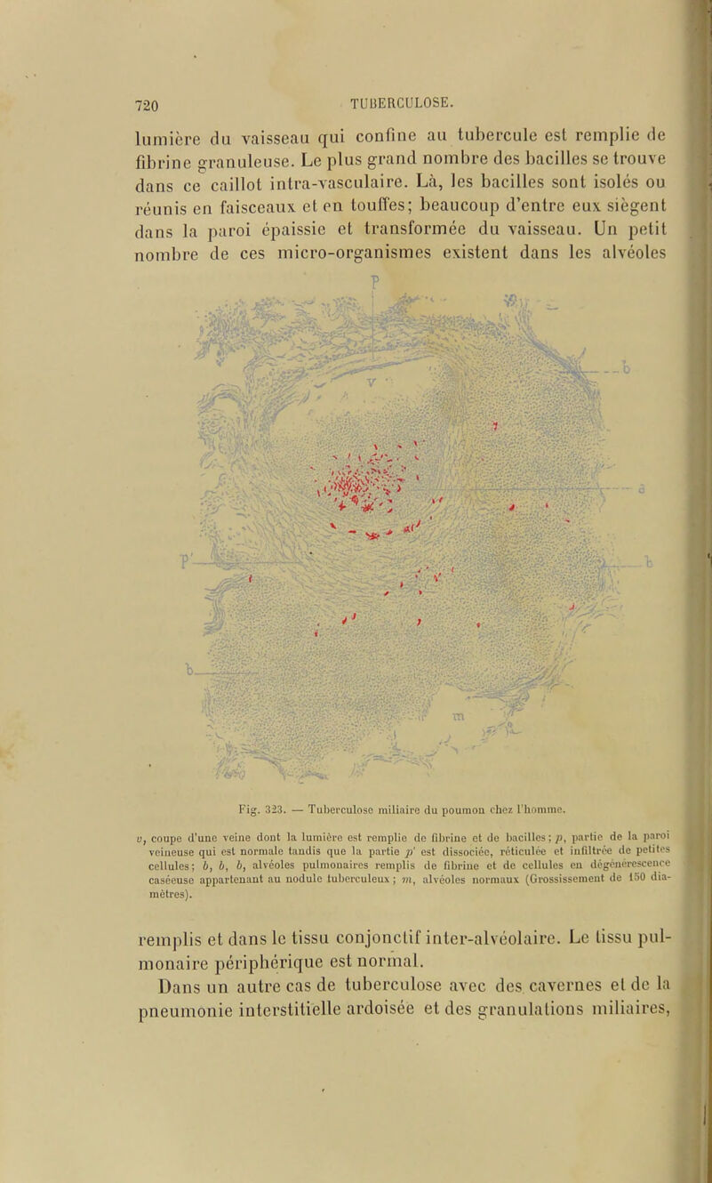 lumière du Vcaisseau qui confine au tubercule est remplie de fibrine granuleuse. Le plus grand nombre des bacilles se trouve dans ce caillot intra-vasculaire. Là, les bacilles sont isolés ou réunis en faisceaux et en touffes; beaucoup d'entre eux siègent dans la paroi épaissie et transformée du vaisseau. Un petit nombre de ces micro-organismes existent dans les alvéoles \ - 1 'V - • P'... Fig. 323. — Tuberculose miliaire du poumon chei; l'homme. u, coupe d'une veine dont la lumière est remplie de fibrine et de l)acilles; /), partie de la paroi veineuse qui est normale tandis que la partie /)' est dissociée, réticulée et infiltrée de petites cellules; 6, b, b, alvéoles pulmouaires remplis de filjrine et de cellules en dégénérescence caséeuse appartenant au nodule tuberculeux ; »i, alvéoles normaux (Grossissement de 150 dia- mètres). remplis et dans le tissu conjonclif inter-alvéolaire. Le tissu pul- monaire périphérique est normal. Dans un autre cas de tuberculose avec des cavernes et de la pneumonie interstitielle ardoisée et des granulations miliaires,