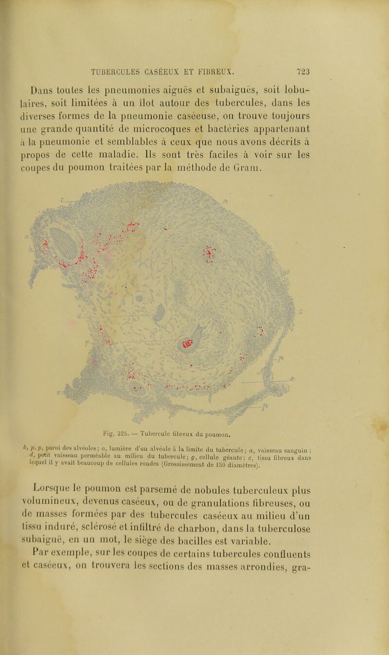 Dans toules les pnouinonies aiguës et subaiguës, soit lobu- iaires, soit limitées à un îlot autour des tubercules, dans les diverses formes de la pneumonie caséeuse, on trouve toujours une grande quantité de microcoques et bactéries appartenant à la pneumonie et semblables à ceux que nous avons décrits à propos de cette maladie. Us sont très faciles à voir sur les coupes du poumon traitées par la méthode de Gram. (y. V Kig. 325. — Tulierculc fibreux du poumou, A. p, p, paroi dos alvéoles ; o, lumière d'uu alvéole a la limite du tubercule ; a, vaisseau sanguin ; d, petit vaisseau perméable au milieu du tubercule; jr, cellule géante; c, tissu fibreux dans lequel il y avait beaucoup de cellules roudcs (Grossissement do luO diamètres). Lorsque le poumon est parsemé de nobules tuberculeux plus volumineux, devenus caséeux, ou de granulations fibreuses, ou de masses formées par des tubercules caséeux au milieu d'un tissu induré, sclérosé et infiltré de charbon, dans la tuberculose subaiguë, en un mot, le siège des bacilles est variable. Par exemple, sur les coupes de certains tubercules confluents et caséeux, on trouvera les sections des masses arrondies, gra-