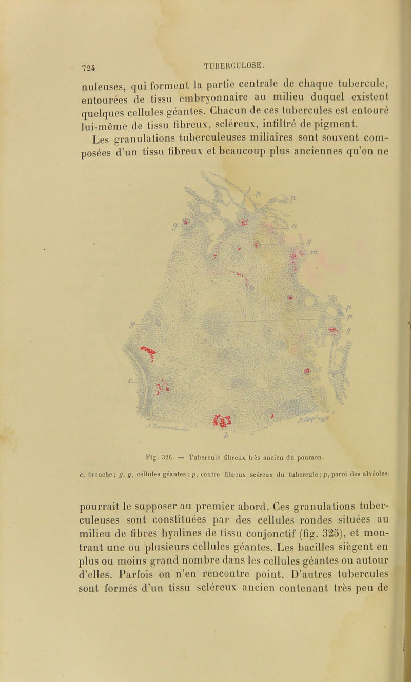 nuleuses, qui forment la partie centrale de chaque tubercule, entourées de tissu embryonnaire au milieu duquel existent quelques cellules géantes. Chacun de ces tubercules est entouré lui-même de tissu fibreux, scléreux, infiltré de pigment. Les granulations tuberculeuses miliaires sont souvent com- posées d'un tissu fibreux et beaucoup plus anciennes qu'on ne Fig. 32G. — Tubercule fibreux très ancien du poumon. c, bronche; g, g, cellules géantes ; p, centre fibreux scércux du tubercule ; ;i, paroi des alvéoles. pourrait le supposer au premier abord. Ces granulations tuber- culeuses sont constituées par des cellules rondes situées au milieu de fibres hyalines de tissu conjonctif (fig. 325), et mon- trant une ou plusieurs cellules géantes. Les bacilles siègent en plus ou moins grand nombre dans les cellules géantes ou autour d'elles. Parfois on n'en rencontre point. D'autres tubercules sont formés d'un tissu scléreux ancien contenant très peu de