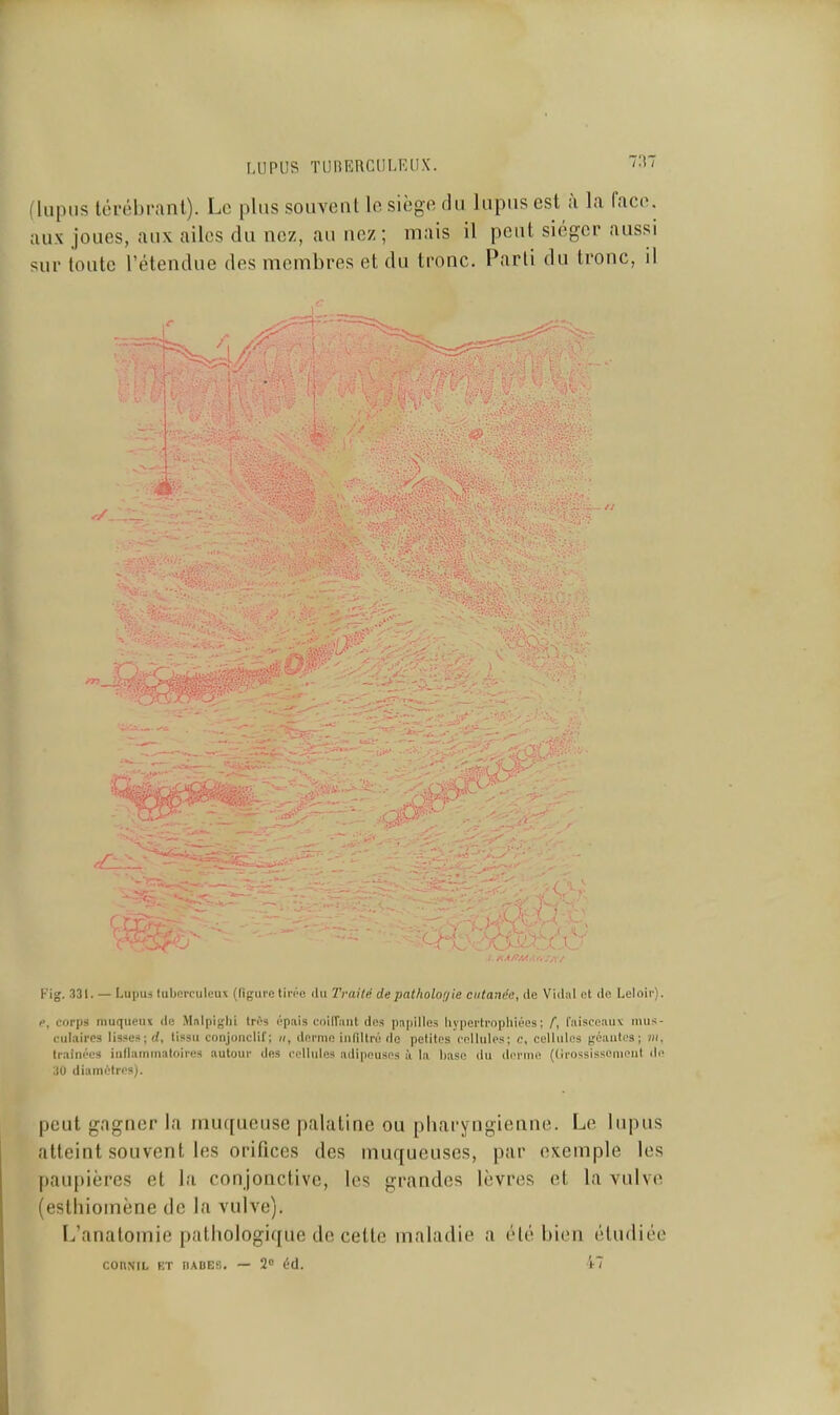 MIPUS TUIIERCIILELIX. (lupus térébnml). Le plus souvent le siège du lupus est ;i la face, aux joues, aux ailes du nez, au nez ; mais il peut siéger aussi sur toute l'étendue des membres et du tronc. Parti du tronc, il Fig. 331. — Lupui tuljoiTuleuv (figure tiri'e il» Traité depatholorjie cutanée, (le Vidiil ot de Leloii'). c, corps muqueux de Mnlpiglii très épais cnilTiuit des pnpilles hypertrophiées; /, fiiisceiiiiv iiuis- lîulaircs lisses; rf, tissu conjonclif; ii, derme iiiflltré do petites cellules; c, cellules géauti?s ; m. Irainéos iiillaminatoiies autour des cellules adipeuses à la hase du deruie ((Irossissemeut de 30 diamètres). peut gagner la muqueuse palatine ou pharyngienne. Le lupus atteint souvent les orifices des muqueuses, par exemple les paupières et la conjonctive, les grandes lèvres et la vulvti (estliiomène de la vulve). L'anatomie pathologique de cette maladie a été bien étudiée