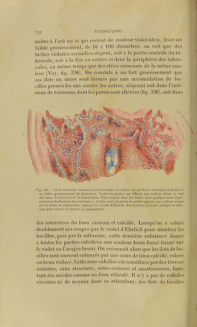 7;52 ÏUlîKRCl'LnSE. naître à l'œil nu ot qui restent de couleur violet-bleu. Avec un faible grossissement, de 10 à 100 diamètres, on voit que des taches violettes arrondies siègent, soit ù la partie centrale du tu- bercule, soit à la fois au centre et dans la périphérie des tuber- cules, en même temps que des stries sinueuses de la môme cou- leur (Voy. fig. 336). On constate à un fort grossissement que ces îlots ou stries sont formés par une accumulation de ba- cilles pressés les uns contre les autres, siégeant soit dans l'inté- rieur de vaisseaux dont les parois sont altérées (fig. 336), soit dans Fig. 336. — Gros tubercule ctiséeux et calcuii'e situé ù lii surface du péritoine intestinal et dessiné à nu l'ailjle grossissement (20 diamètres). Toutes les parties qui olTrent une couleur bleue, h, sont (les amas de bactéries de la tuberculose. Elles siègent dans des fentes dont qnelqurs-nnes repi-é- sentent probablement des vaisseaux v, et elles sont entourées de parties qui ont une conleiu' acajou par le mode de préparation employé ici (violet d'Ebrlicli, décoloration à l'acide nitrique ot safra- nine pour colorer le fond de la préparation). des interstices du tissu caséeux et calcifié. Lorsqu'on a coloré doublement ces coupes par le violet d'Ehrlich pour montrer les bacilles, puis par la safranine, cette dernière substance donne à toutes les parties calcifiées une couleur brun foncé tirant sur le violet ou l'acajou bruni. On reconnaît alors que les îlots de ba- cilles sont souvent entourés par une zone de tissu calcifié, coloré en brun violacé. Cette zone calcifiée est constituée par des travées anhistes, sans structure, entre-croisées et anastomosées, limi- tant des aréoles comme un tissu réticulé. Il n'y a pas de cellules vivantes ni de noyaux dans ce réticulum; des îlots de bacilles