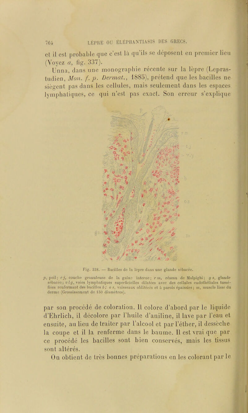 et il est probable que c'est là qu'ils se déposent en premier lieu (Voyez «, fig. 337). Unna, dans une monographie récente sur la lèpre (Lepras- tudien, Mon. f. p. Dermat., 1885), prétend que les bacilles ne siègent pas dans les cellules, mais seulement dans les espaces lymphatiques, ce qui n'est pas exact. Son erreur s'explique ■ V Fig. 338. — Bacilles de la lèpre dans une glande sébacée. 23, poil; cj, couche granuleuse de la gain; interne; r m, réseau de Malpighi; {/s, glande sébacée; uZi/, voies lympliatiqiies superficielles dilatées avec des cellules endothéliales tumé- fiées renfermant des bacilles b; o s, vaisseaux oblitérés et à parois épaissies; m, muscle lisse du derme (Grossissement de 130 diamètres). par son procédé de coloration. 11 colore d'abord par le liquide d'Ehrlich, il décolore par l'huile d'aniline, il lave par l'eau et ensuite, au lieu de traiter par l'alcool et par l'éther, il dessèche la coupe et il la renferme dans le baume. Il est vrai que par ce procédé les bacilles sont bien conservés, mais les tissus sont altérés. On obtient de très bonnes préparations en les colorant par le