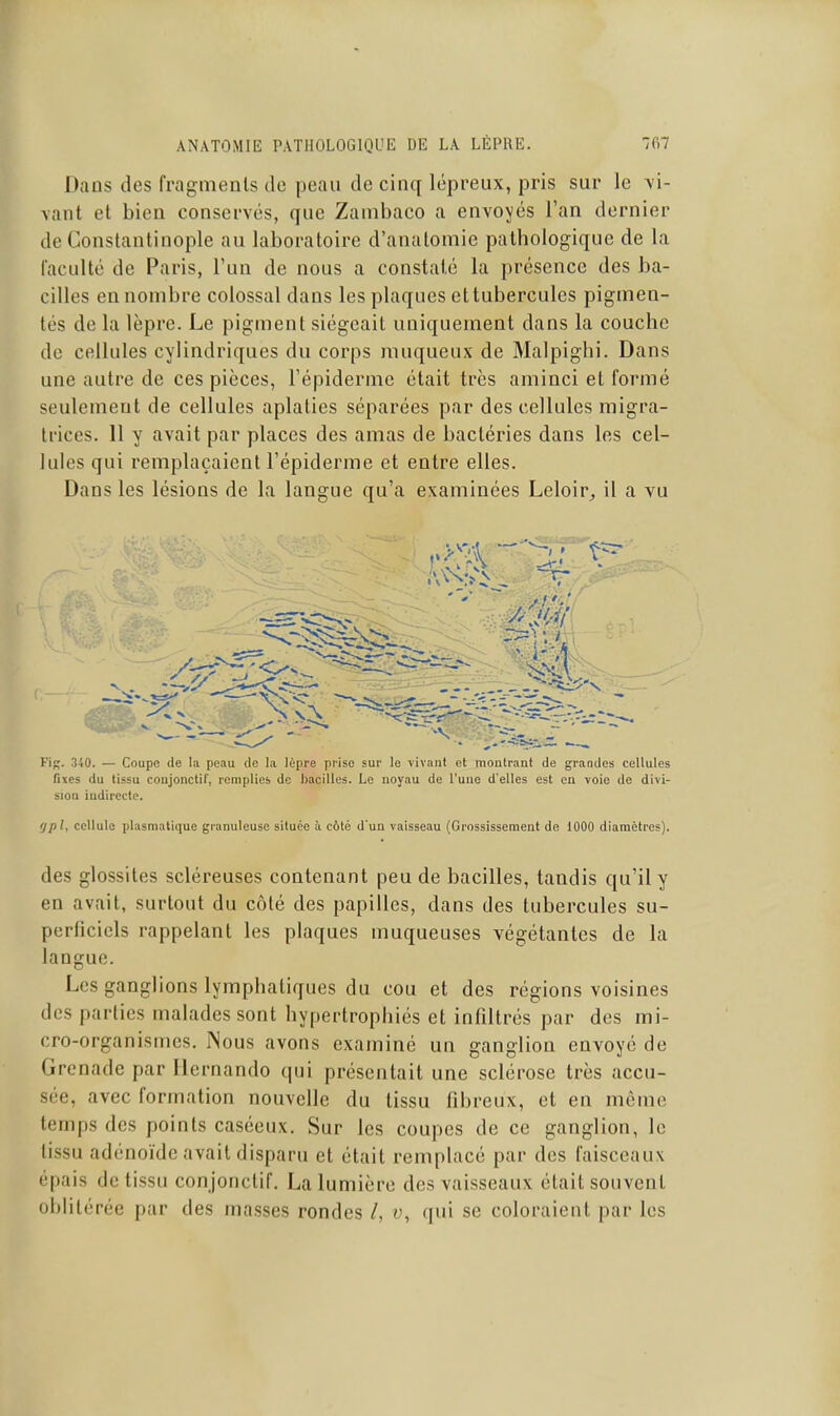 Dans des fragments de peau de cinq lépreux, pris sur le vi- vant et bien conservés, que Zambaco a envoyés l'an dernier de Constantinople au laboratoire d'analomie pathologique de la faculté de Paris, l'un de nous a constaté la présence des ba- cilles en nombre colossal dans les plaques ettuberculcs pigmen- tés de la lèpre. Le pigment siégeait uniquement dans la couche de cellules cylindriques du corps muqueux de Malpighi. Dans une autre de ces pièces, l'épidermc était très aminci et formé seulement de cellules aplaties séparées par des cellules migra- trices. Il y avait par places des amas de bactéries dans les cel- lules qui remplaçaient l'épiderme et entre elles. Dans les lésions de la langue qu'a examinées Leloir^ il a vu FiR. 340. — Coupe de la peau de la lèpre prise sur le vivant et montrant de grandes cellules fixes du tissu conjonctif, remplies de bacilles. Le noyau de l'une d'elles est en voie de divi- sion indirecte. 'jpl, cellule plasmatique granuleuse située à côté d'un vaisseau (Grossissement de 1000 diamètres). des glossites scléreuses contenant peu de bacilles, tandis qu'il y en avait, surtout du côté des papilles, dans des tubercules su- perficiels rappelant les plaques muqueuses végétantes de la langue. Les ganglions lymphatiques du cou et des régions voisines des parties malades sont hypertrophiés et infiltrés par des mi- cro-organismes, INous avons examiné un ganglion envoyé de Grenade par Ilernando qui présentait une sclérose très accu- sée, avec formation nouvelle du tissu fibreux, et en môme temps des points caséeux. Sur les coupes de ce ganglion, le tissu adénoïde avait disparu et était remplacé par des faisceaux épais de tissu conjonctif. La lumière des vaisseaux était souvent oblitérée par des ma.sses rondes /, t>, qui se coloraient par les