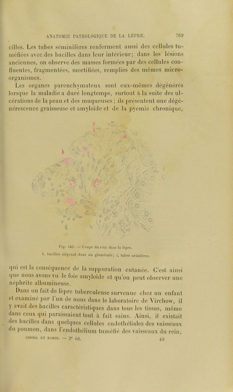 cilles. Les tubes séminifèrcs renferment aussi des cellules tu- méfiées avec des bacilles dans leur intérieur; dans les lésions anciennes, on observe des masses formées par des cellules con- fluentes, fragmentées, mortifiées, remplies des mômes micro- organismes. Les organes parcnchymateux sont eux-mêmes dégénérés lorsque la maladie a duré longtemps, surtout à la suite des ul- cérations de la peau et des muqueuses ; ils présentent une dégé- nérescence graisseuse et amyloïde et de la pyémie chronique, 342. — Coupe du rein daus lu U'.pre. b, bacilles siégeant dans un glomérule; tubes urinifèies. qui est la conséquence de la suppuration cutanée. C'est ainsi ([ue nous avons vu le foie amyloïde et qu'on peut observer une néphrite albumineuse. Dans un fait de lèpre tuberculeuse survenue chez un enfant et examiné par l'un de nous dans le laboratoire de Virchow, il y avait des bacilles caractéristiques dans tous les tissus, même dans ceux qui paraissaient tout à fait sains. Ainsi, il existait des bacilles dans quelques cellules endothéliales des vaisseaux du poumon, dans l'endothélium tuméfié des vaisseaux du rein, COnNIU ET BADES. — 2 Cd. .S*)