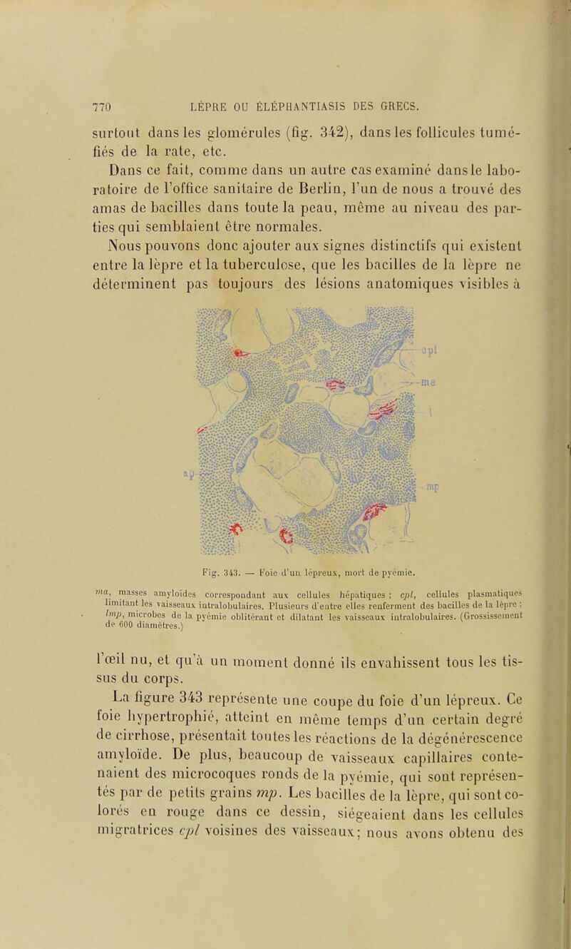 surtout dans les glomérules (fig. 342), dans les follicules tumé- fiés de la rate, etc. Dans ce fait, comme dans un autre cas examiné dans le labo- ratoire de l'office sanitaire de Berlin, l'un de nous a trouvé des amas de bacilles dans toute la peau, môme au niveau des par- ties qui semblaient être normales. Nous pouvons donc ajouter aux signes distinctifs qui existent entre la lèpre et la tuberculose, que les bacilles de la lèpre ne déterminent pas toujours des lésions anatomiques visibles à Fig. 343. — l-'oie d'un lépreux, mort de pyémic. amj'loïdes correspondant aux cellules hépatiques ; cpl, cellules plasmatiques s vaisseaux intralobulaires. Plusieurs d'entre elles reufermeut des bacilles de la lèpre : ma, masses limitant les bnp, microbes de la pyémie oblitérant et dilatant les vaisseaux intralobulaires. (Grossissement de 600 diamètres.) l'œil nu, et qu'à un moment donné ils envahissent tous les tis- sus du corps. La figure 343 représente une coupe du foie d'un lépreux. Ce foie hypertrophié, atteint en même temps d'un certain degré de cirrhose, présentait toutes les réactions de la dégénérescence amyloïde. De plus, beaucoup de vaisseaux capillaires conte- naient des microcoques ronds de la pyémie, qui sont représen- tés par de petits grains mj). Les bacilles de la lèpre, qui sont co- lorés en rouge dans ce dessin, siégeaient dans les cellules migratrices cpl voisines des vaisseaux; nous avons obtenu des