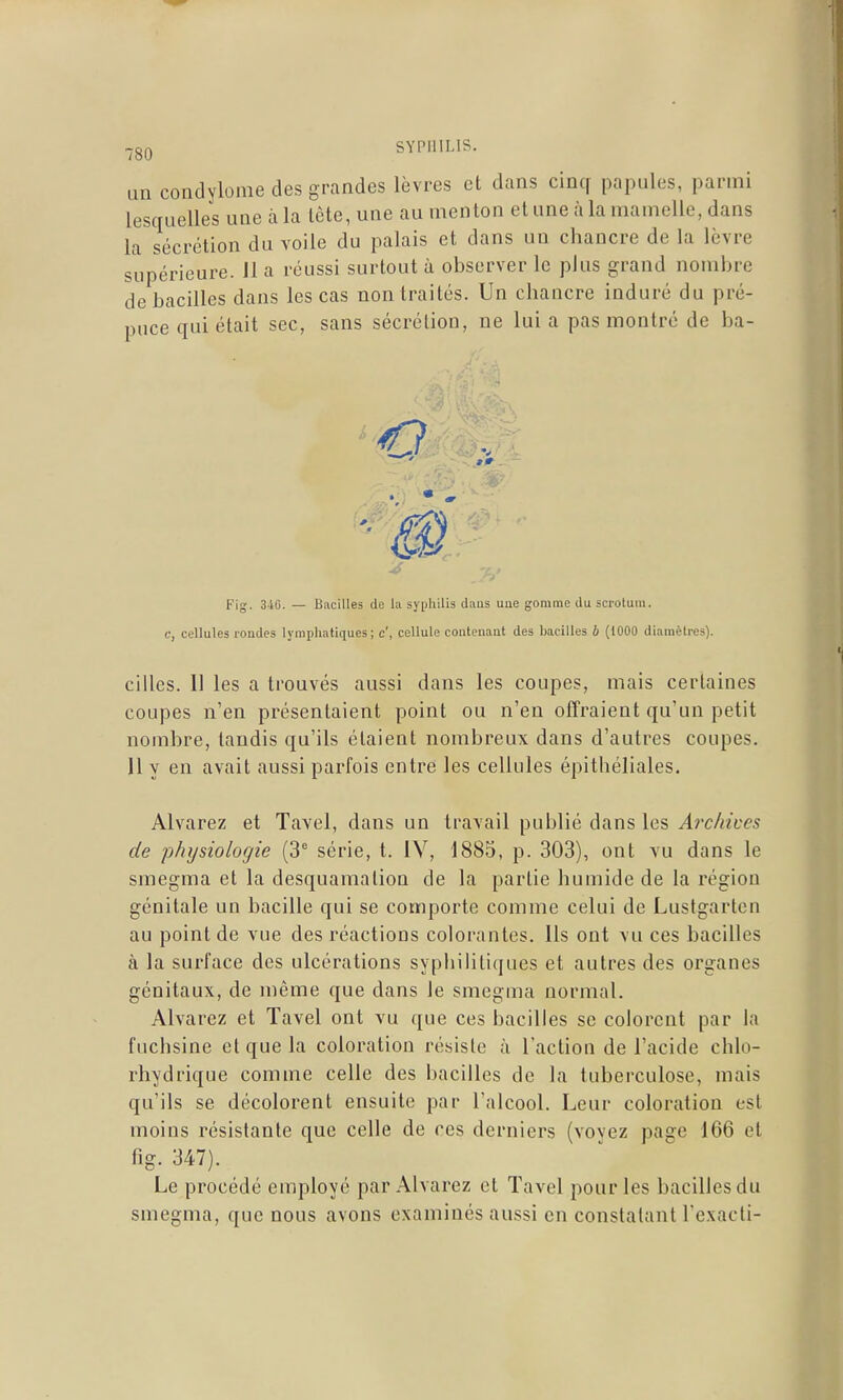 un condylome des grandes lèvres et dans cinq papules, parmi lesquelles une à la Icte, une au menton et une à la mamelle, dans la sécrétion du voile du palais et dans un chancre de la lèvre supérieure. 11 a réussi surtout à observer le plus grand nombre de bacilles dans les cas non traités. Un chancre induré du pré- puce qui était sec, sans sécrétion, ne lui a pas montré de ba- Fig. 3iG. — Biicilles de la syphilis dans une gomme du scrotum. c, cellules roudes lymphatiques; c', cellule contenaat des bacilles b (1000 diamètres). cilles. Il les a trouvés aussi dans les coupes, mais certaines coupes n'en présentaient point ou n'en offraient qu'un petit nombre, tandis qu'ils étaient nombreux dans d'autres coupes. 11 y en avait aussi parfois entre les cellules épithéliales. Alvarez et Tavel, dans un travail publié dans les Archives de physiologie (3' série, t. IV, 1885, p. 303), ont vu dans le smegma et la desquamation de la partie humide de la région génitale un bacille qui se comporte comme celui de Lustgarten au point de vue des réactions colorantes. Ils ont vu ces bacilles à la surface des ulcérations syphilitiques et autres des organes génitaux, de même que dans le smegma normal. Alvarez et Tavel ont vu que ces bacilles se colorent par la fuchsine et que la coloration résiste à l'action de l'acide chlo- rhydrique comme celle des bacilles de la tuberculose, mais qu'ils se décolorent ensuite par l'alcool. Leur coloration est moins résistante que celle de ces derniers (vovez page 166 et fig. 347). Le procédé employé par Alvarez et Tavel pour les bacilles du smegma, que nous avons examinés aussi en constatant l'exacti-