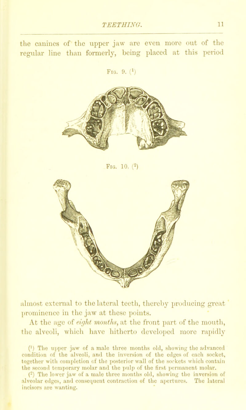 the canines of the upper j;i\v urc even more out of the reguhxr line th;\n formerly, being placed at this iieriod Fi3. 9. (') almost external to the lateral teeth, therehy producing great prominence in the jaw at these points. At the age of eight montlis, at the front part of the moutli, the alveoli, which have hitherto developed more rajjidly (') Tlie iqipcr jaw of a male tlirec months old, sliowini; tlic advanced condition of the alveoli, and the invoreion of the edges of each socket, together with completion of the posterior wall of tlie sockets wliich contain tiie second temporary molar and the pul[) of the first ]icrnianent molar. (-) The lower jaw of a male three montiis old, showing the inversion of alveolar edges, and consequent contraction of the apertures. The lateral incisors are wanting.