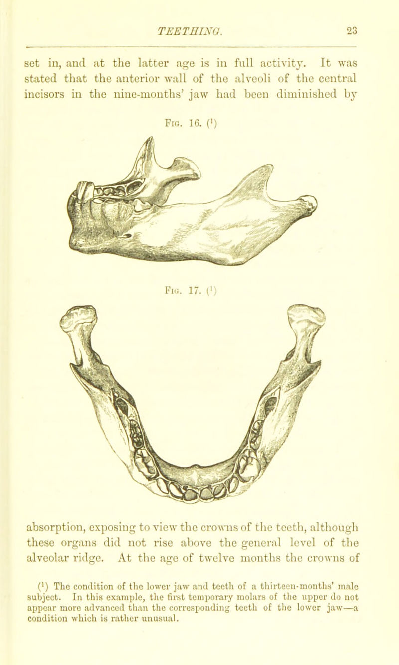 set in, and at the latter age is in full activity. It was stated that the anterior wall of the alveoli of the central incisors in the nine-months' jaw had been diminished by Fig. 16. (') absorption, exposing to view the croMTis of the teeth, although these organs did not rise above the general level of the alveolar ridge. At the age of twelve months the crowns of (') The condition of tlie lower jaw and tectli of a tliirtoen-montlis' male subject. In this example, the first temporary molars of the upper do not appear more advanced than the corresponding teeth of tlio lower jaw—a condition which is rather unusual.