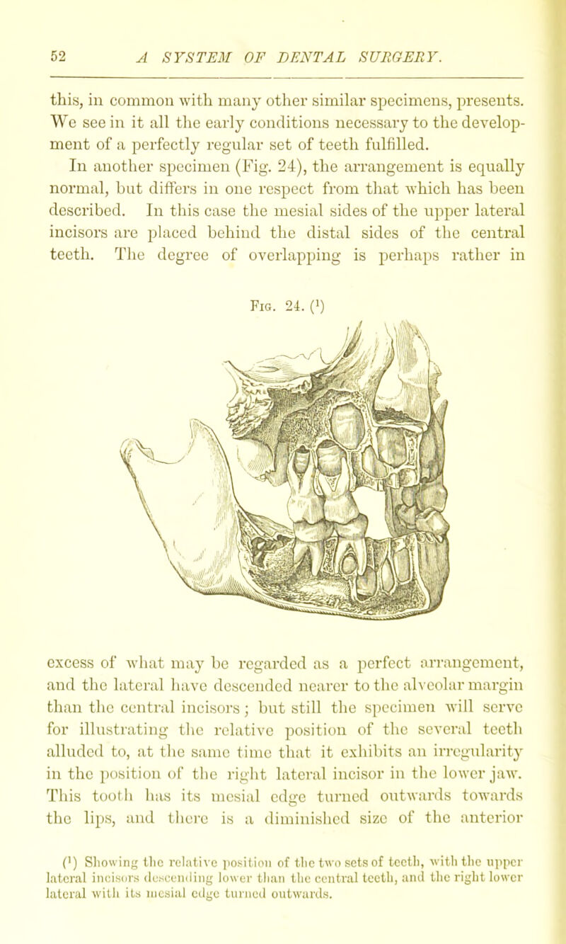 this, in common with many other similar specimens, presents. We see in it all the early conditions necessary to the develop- ment of a perfectly regular set of teeth fulfilled. In another specimen (Fig. 24), the arrangement is equally normal, but differs in one respect from tliat which has been described. In this case the mesial sides of the upper lateral incisors are placed behind the distal sides of the central teeth. The degree of overlapping is perhaps rather in Fig. 24. Q) excess of what may be regarded as a perfect arrangement, and the lateral liave descended nearer to the alveolar margin than the central incisors; but still the specimeii will serve for illustrating tlie relative position of the several teeth alluded to, at the same time that it exhibits an irregularity in the jiosition of the right lateral incisor in the lower jaw. This tooth has its mesial edge turned outwards towards the lips, and tliure is a diminished size of the anterior (') Showing tlic relative posiiiioii of tlic two sets of tcctli, witlitlie upper lateral iiicisdvs dusceiuling lower than the central teeth, and the right lower lateral witli its mesial edge turned outwards.