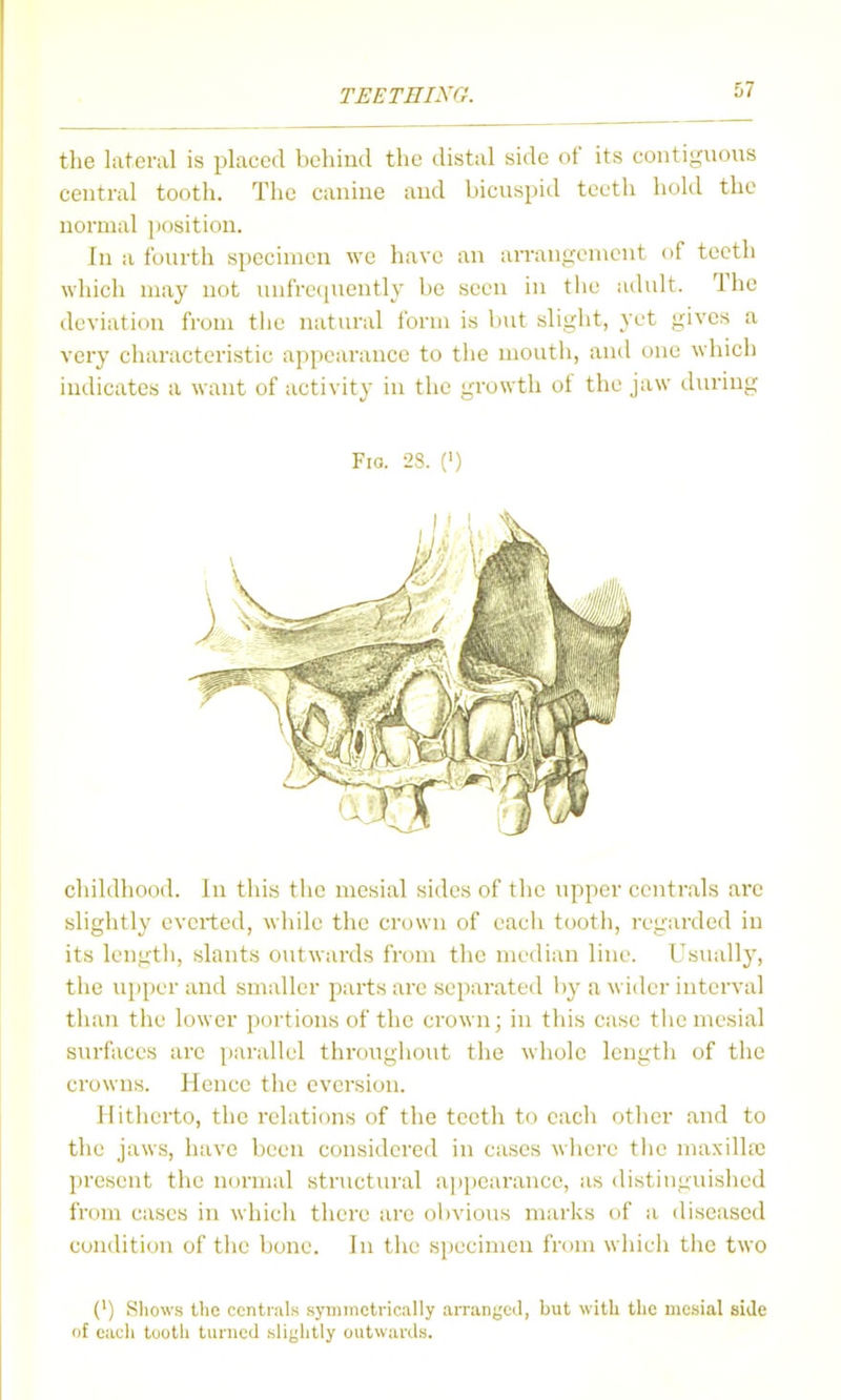 tlie lateral is placed behind the distal side of its contiguous central tooth. The canine and bicuspid teeth hold the normal position. In a fourth specimen we have an arrangement of teeth which may not unfrequently be seen in the adult. The deviation from the natural form is but slight, yet gives a very characteristic appearance to the mouth, and one which indicates a want of activity in the growth of the jaw during Fio. 23. (') childhood. In this the mesial sides of the upper centrals arc slightly everted, while the crown of eacli tooth, regarded in its lengtli, slants outwards from the median line. Usually, the upper and smaller parts are separated by a wider interval tluui the lower portions of the crown; in this case tiie mesial surfaces are parallel throughout the whole length of the crowns. Hence the eversion. Hitherto, the relations of the teeth to each other and to the jaws, have been considered in cases where tiie maxilhc l)resent the normal structural appearance, as distiuguished from cases in whieii there are ol)vious marks of a diseased condition of the bone. In the sjjecimen from whicii tlic two (') Shows the centrals symmctvicnlly aiTanged, but with the mesial side of eacli tooth turned slightly outwarils.