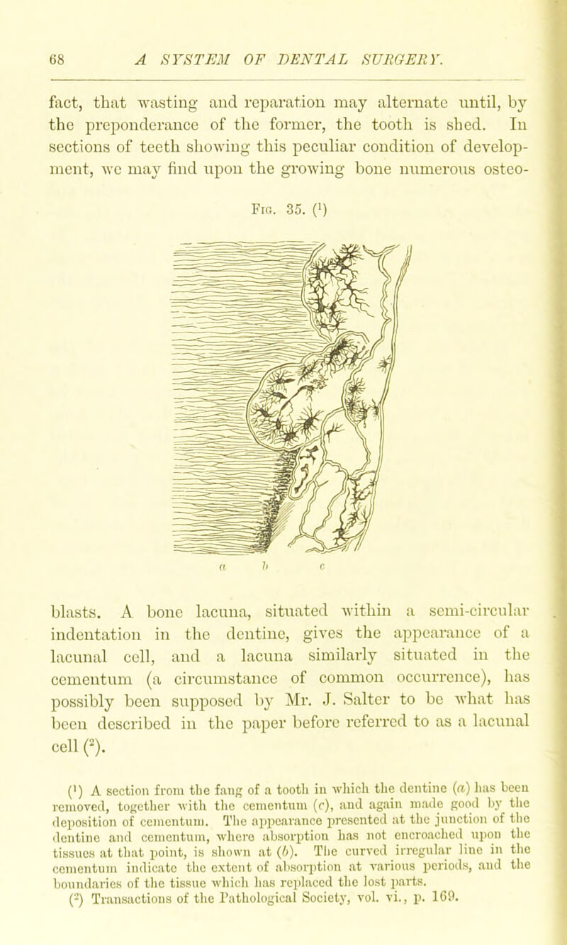 fixct, that wasting and reparation may alternate until, by the preponderance of the former, the tooth is shed. In sections of teeth showing this peculiar condition of develop- ment, wc may find upon the growing bone numerous osteo- FiG. 35. (') (I h c blasts. A bone lacuna, situated within a semi-circular indentation in the dentine, gives the appearance of a lacunal cell, and a lacuna similarly situated in the cementum (a circumstance of common occurrence), has possibly been supposed by Mr. J. Salter to be what has been described in the paper before referred to as a lacunal cell C). (') A section fi-oiu the fang of a tooth in wliicli the dentine (re) lias been removed, together with tlie ccmentnni (c), and again made good by the deposition of cementum. Tlic appearance presented at the junction of the dentine and cementum, where absorption has not encroaclied upon tlie tissues at that point, is sliown at (6). Tlie curved irreguhir line in the cementum indicate the extent of absorption at various periods, and the boundaries of the tissue which has replaced the lost parts. {-) Transactions of the Pathological Society, vol. vi., p. 1C9.