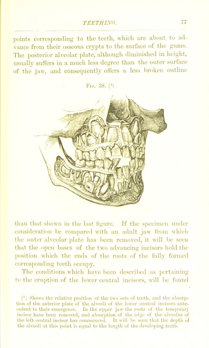 lK)ints coiTcsponding to the teeth, which are about to ad- vance from their osseous crypts to the surface of tiie liums. The posterior alveolar plate, although diminished in lieight, usually suffers in a much less degree than the outer surface of tlic jaw, and consequently offers a less hrokeii outline Fig. 3S. (') tiiau tliat siiowu in the last figure. If the specimen under consideration lie compared with an adult jaw from whicii tlie outer alveolar plate lias lieen removed, it will be seen that the open bases of the two advancing incisors hold the pf)sition whicli the ends of tlie roots of tlie fully formed corresponding teeth occupj-. The conditions wliicii have been described as pei'taining to tiie eruption of the lower central incisors, will be found (') Sliows the relative jinsitiiHi of tlic two sots of tcetli, and the riKsoq)- tioii of tlie anterior plate of the alveoli of the lower central inci.siir.s ante- eetlcnt to their emergenee. In the ujiiier jaw the roots of the teni]iorarv ineisor have been removed, and ahsorption of the edge of the alveolus of the left central incisor has commenced. It will lie seen that tlie depth of the alveoli at this jjoiut is eiiual to the length of the developing teeth.