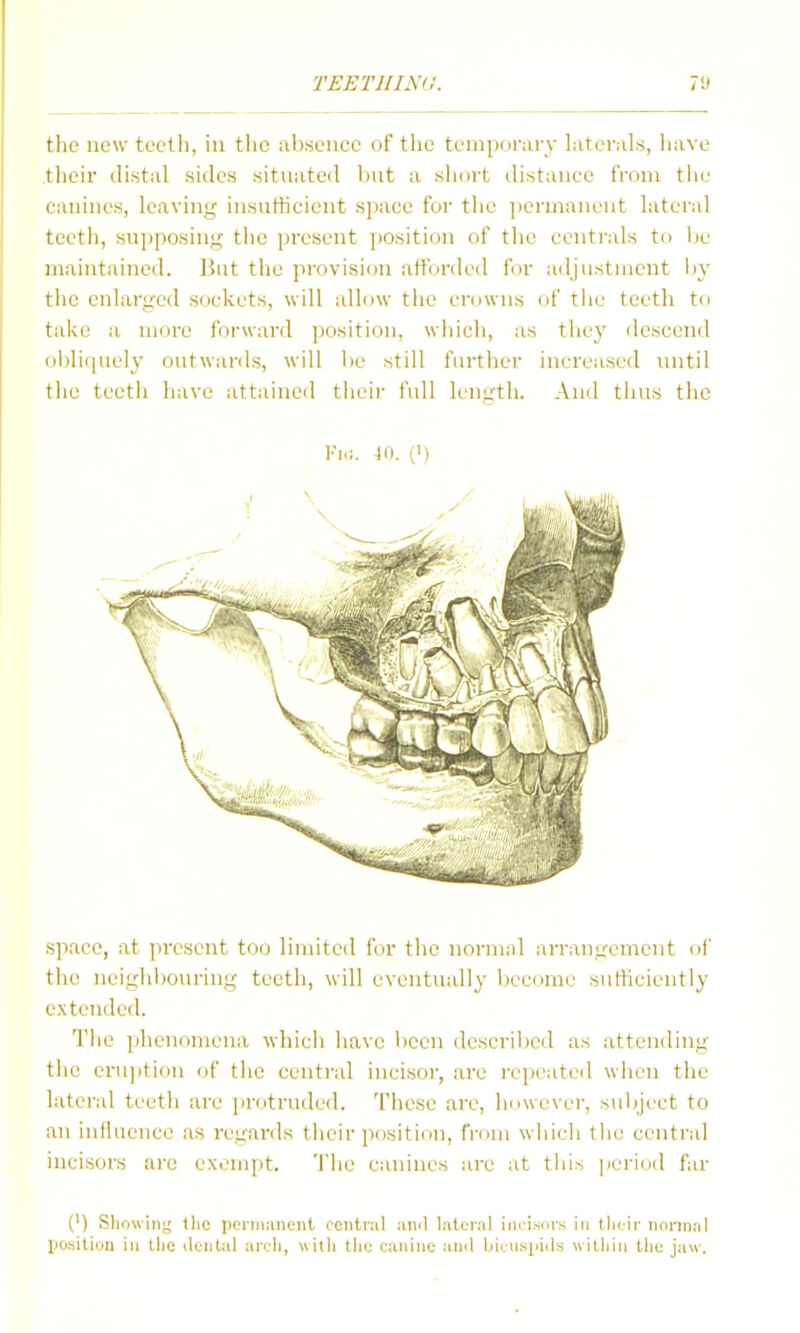 the new teeth, in tlic absence of the temporary Literals, liave their distal sides situated but a short distance from tiie canines, leaving insnthcient space for tlie permanent lateral teeth, sui)posing the present i)Osition of the centrals to Ite maintained, liut the provision afforded for adjustment Ity the enlarged sockets, will allow the crowns of tlie teeth to take a more forward jjosition, whicli, as they descend ol3lif[Ucly outwai-ils, will be still furtlier increased luitil the teetli have attaineil theii- full length. And tlius the Fi(!. 40. (') space, at present too limited for the normid arrangement of the neighbouring teeth, will eventually become sutliciently extended. The pjhenomeua whicii liave been descrilied as attending the eruj)tion of the central incisor, are repeated wlien the lateral teeth are protruded. These arc, however, sui)ject to an influence as regards their position, from which the central incisors are exempt. 'Jhe canines are at this [>eriod far (') Showini^ tlic periiiiuient oeiitnil ami lateral iiifi.snrs in tlitir iinnnal position ill the ileiital aix-li, witli the canine and biciispiils within the jaw.