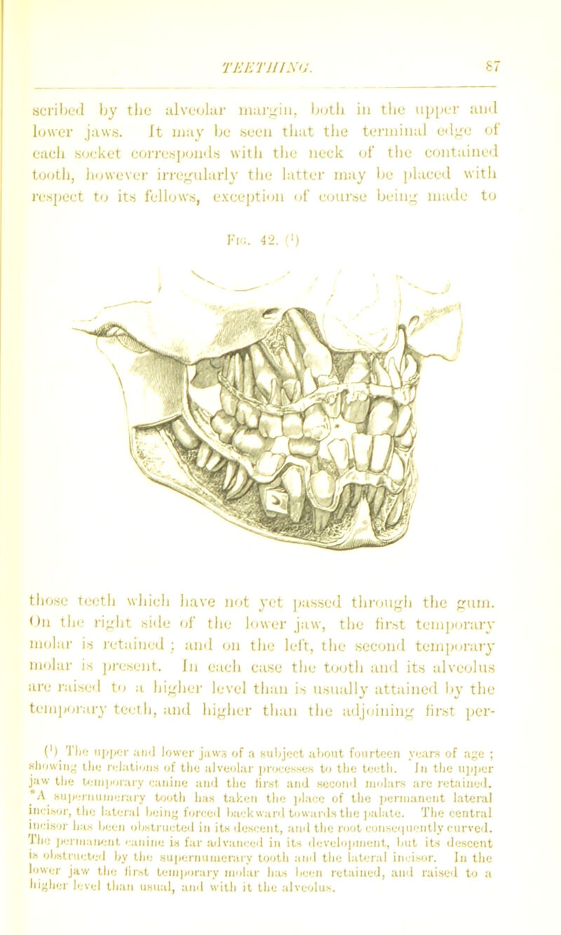 TKKTHIXU. 67 scriljcd by the ulveuhir iiiai-iiiu, buth in tliu iip[ier ami lower jawrt. Jt may l^e iseeu that the terniiiuil edue of each .socket corre.sjjoiuls witli tlie neck of the contained tooth, hmvever iiTe;irularly the latter may be phiced witli respect to its fellows, exception (jf course being made to Kl':. 42. (') those te«;th wliicli have not yet jjassed tlirougii the prum. On the riglit side of the lower jaw, the tir.st temporary molar is letained ; and on the left, tlie second temporary molar is present. In each case the tooth and its alveolus iire raisc'l to a hi^iher level than is usually attained liy the temporary te<.-i-h, and higher than the adjoining first per- (')_ Til'; ii]i];fT aii<l lower jaw.s of a subject aliout fourtocii years of a;,'e ; Kliowiiig llic Halations of the .-ilveolru- jtroeesses to tlic teetli. Jii tlie upper j;iw tlie leiijiiorary ';;iiii)ie ami tlie lir.st and seeoml uiulans are retaineil. *A fiii|)eiiiiiriierary tootli has taken the jil.iee of the peniiatieiit lateral iiici.vjr, the l;it<;ral heiiig foreed ha'.-kw.-ml towards the jialate. The central incisor has been ohsiructed in its descent, ami the root coiisei|iicntly curved. The j/eriiiaiient i:anine i.s far adv.-mced in its develojinient, hut its descent IS obstructed by the supernuiiieraiy tooth and the lateral inci.sor. In the lower jaw the first teinijorary ni'ilar has been retained, and raised to a higher h;vel than usual, and with it the alveolus.