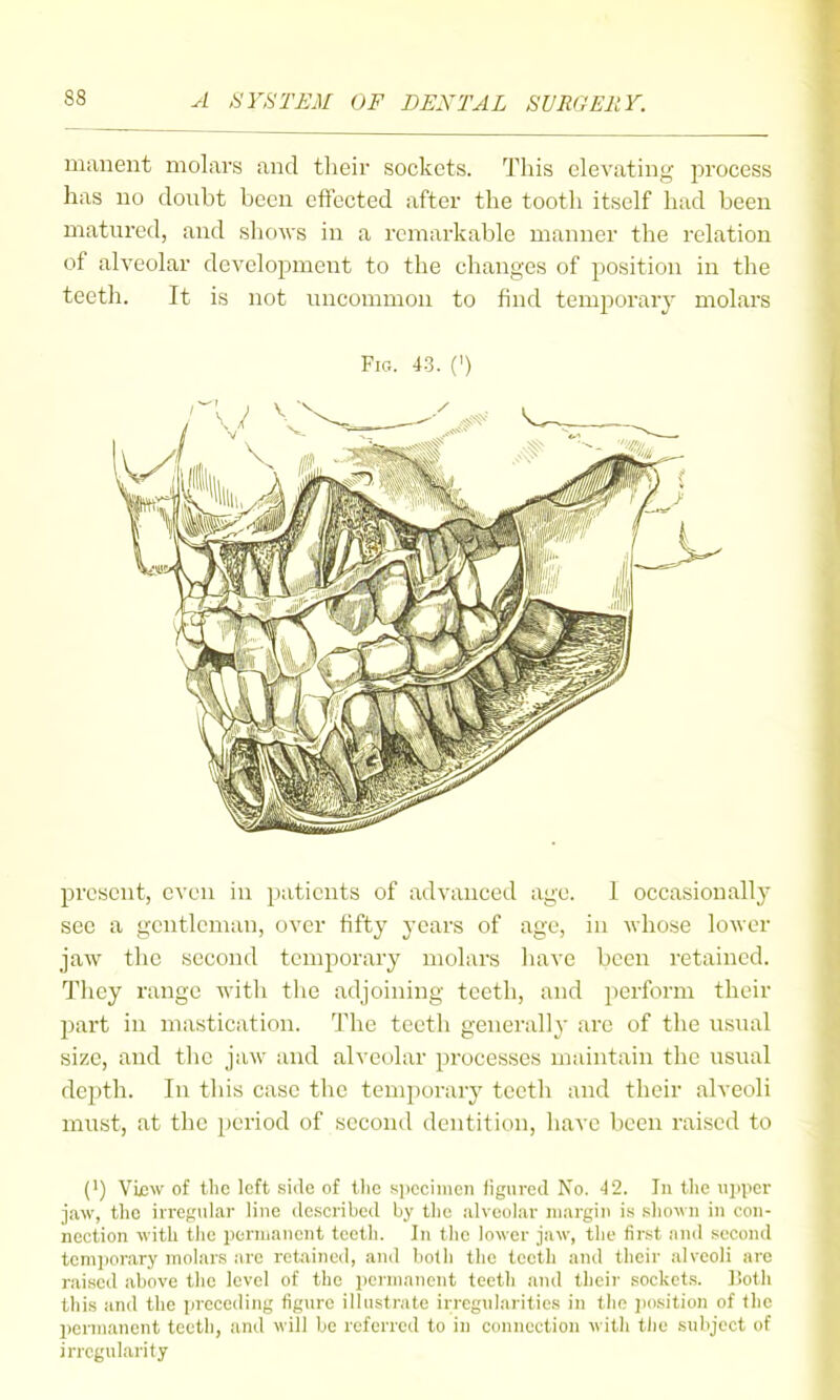 manent molars and their sockets. This elevating process has no donbt been effected after the tooth itself had been matured, and shows in a remarkable manner the relation of alveolar development to the changes of position in the teeth. It is not uncommon to find temporary molars Fig. 4-3. (') present, even in patients of advanced age. I occasionally see a gentleman, over fifty years of age, in whose lower jaw the second temporary molars have been retained. They range with the adjoining teeth, and perform their part in mastication. The teeth generally are of the usual size, and the jaw and alveolar processes maintain the usual depth. In this case the temporary teeth and their alveoli must, at the period of second dentition, have been raised to (•) View of the left side of Uic s;i)ccimcn figured No. 42. In the tipiier jaw, the irregidar line described by the alvcohir margin is .sliown in con- nection with tiie pennancnt teeth. In tlie lower jaw, the first and second tcm])orary molars are retained, and both the teeth and their alveoli arc raised above the level of the permanent teeth and their sockets. ]5oth this and the iircceding figure illustrate irregularities in the ]iosition of the permanent teeth, and will be referred to in connection with the subject of irregularity