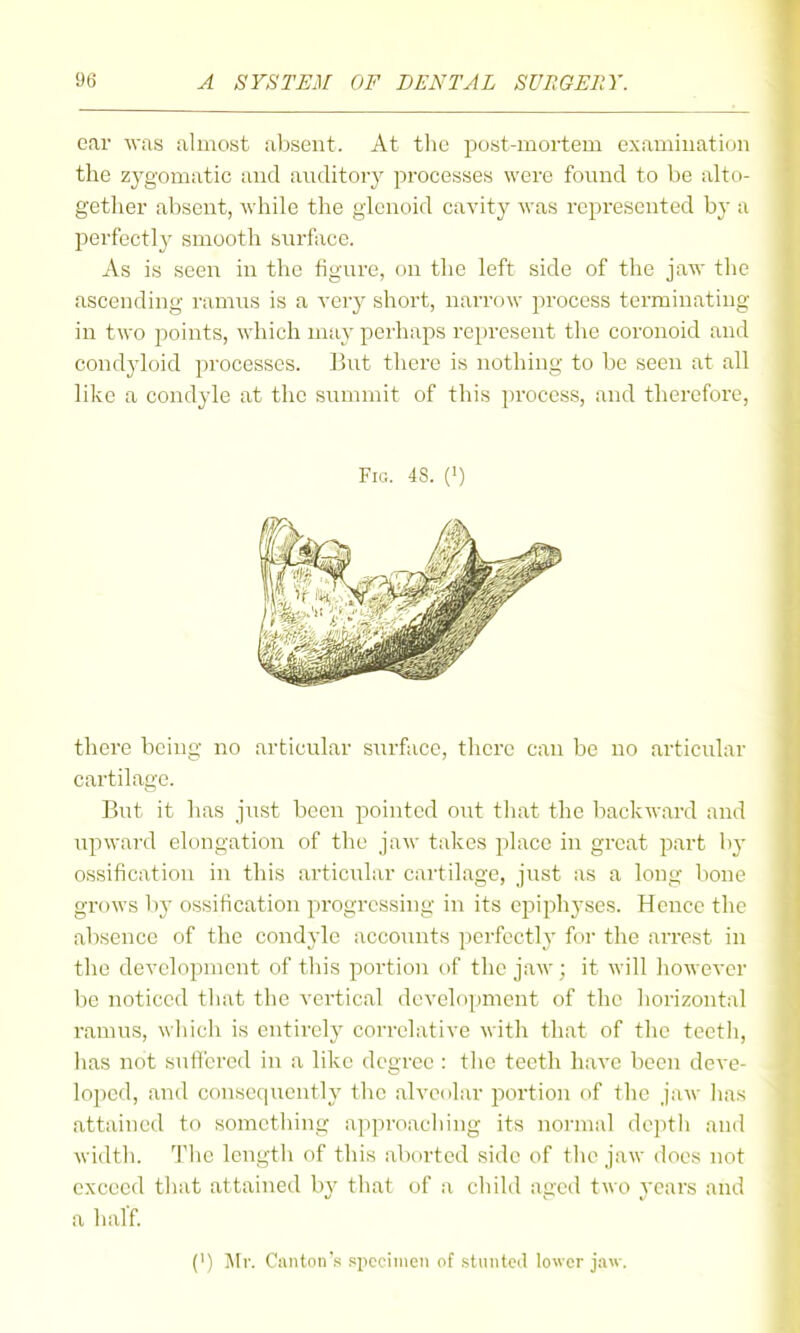 oar was almost absent. At tlie post-mortem examiuatioii the zygomatic and auditory processes were found to be alto- gether absent, while the glenoid cavity was represented by a perfectly smooth surface. As is seen in the figure, on the left side of the jaw the ascending ramus is a very short, narrow process terminating in two points, which may perhaps represent the coronoid and condyloid processes. But there is nothing to be seen at all like a condyle at the summit of this i)roccss, and therefore. Pig. 48. (') there being no articular surface, there can be no articular cartilage. But it has just been pointed out that the backward and upward elongation of the jaw takes place in great part by ossification in this articular cartilage, just as a long bone grows by ossification progressing in its epiphyses. Hence the absence of the condyle accounts perfectly for the aiTest in the development of this portion of the jaw ; it will however be noticed that the vertical development of the liorizontal ramus, which is entirely correlative with that of the teeth, has not sufi'cred in a like degree : the teeth have been deve- loped, and consequently the alvecilar portion of the jaw has attained to something approaching its normal deptii and width. The length of this aborted side of the jaw does not exceed that attained by that of a child aged two years and a hal'f (') J\Ir. Cantnn'.s spcciineii of .stunted lower jaw.