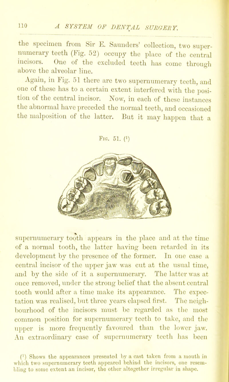 the specimen from Sir E. Saunders' collection, two super- niimerary teeth (Fig. 52) occupy the place of the central incisors. One of the excluded teeth has come through above the alveolar line. Again, in Fig. 51 there are two supernumerarj^ teeth, and one of these has to a certain extent interfered with the posi- tion of the central incisor. Now, in each of these instances the abnormal have preceded the normal teetli, and occasioned the malposition of the latter. But it may happen that a Fio. 51. (') supernumerary tooth appears in the place and at tlie time of a normal tooth, the latter having been retarded in its development by the presence of the former. In one case a central incisor of the upper jaw was cut at the usual time, and by the side of it a supcrmimerary. The latter was at once removed, under the strong belief tliat the absent central tooth would after a time make its appearance. The expec- tation was realised, but three j'cars elapsed first. Tlie neigh- bourhood of tlie incisors must be regarded as the most common position for supcrmimerarv teeth to take, and tlio u]ipcr is more frequently favoured than tlie lower jaw. An extraordinary' case of supernumerary teetli lias been (') Shows tlic appearances ))reseuteil by a cast taken from a mouth in wliich two supernanicrary tcetli appeared liehind the incisors, one resem- bling to some e.xteut au incisor, the other alto^'etlier irregular in sliape.