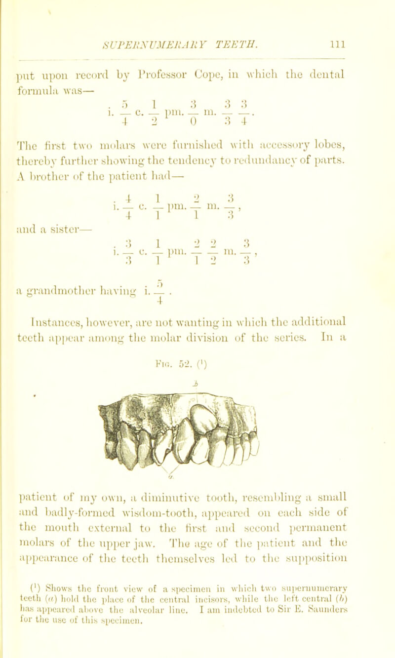 put upon record by l'rofe«:si)r Cope, in which the dcutul fonauLi was— . .-) 1 ;5 3 :5 1. — 0. — imi. — ni. — — 4 2 () .S 4 The first two molars were i'nriushed witli accessory lobes, tliereby furtlier showing the tendency to redundancy of parts. A bnitlier of tlie jiatient liad— .41 -1 :\ 1. — c. — inu. _ ni. — , 4 I ' I and a sister— . 1 -1 -1 W 1. — c. — WW. ni. — , ;] 1 1 -1 a rrandniotlier having' i. — . 4 Instances, liowever, are not wanting in wiiich tlie additirmal teeth appear among tlie molar division of the series. In a Fi.;. (') i jiaticnt of my own, a diminutive tooth, resembling a small and l)adly-formed wisiloni-tootli, appeared on each side of the moutli external to tlie first and second ]icnnancnt molars of the upper jaw. 'I'liu age of the patient and the appearance of the teeth themselves led to the supi)osition (') Shows the iVdiit viuw of a siiociiiien in wliii4i twn .siiiicrmiiiicnirv tectli ((() liold tlic iilacc uf the poiitral iiicisnrs, wliili; tJic hit't central (h) I1.1.S ai)])carcil ahovc tho alveohir lino. I am indebted to Sir U. Saundcr.s for the ii.sc of this spefinien.