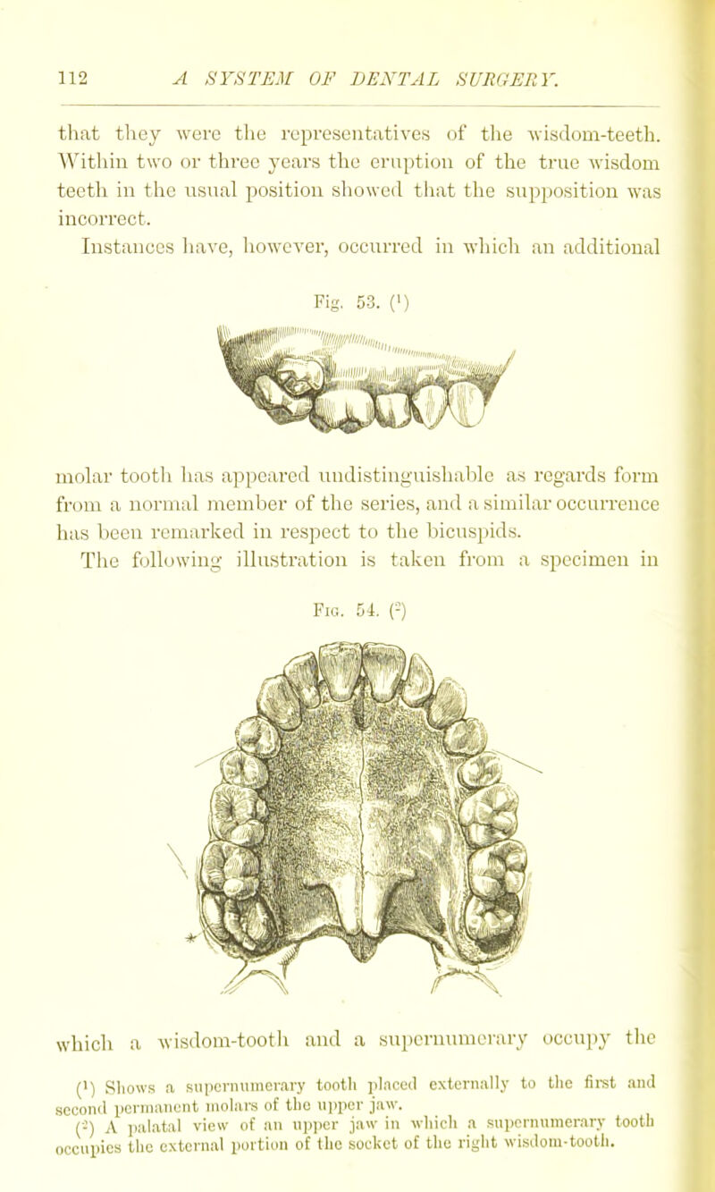 that they were the representatives of tlie wisdom-teeth. Within two or three years the ernption of the true wisdom teeth in the usual position sliowed tliat the supposition was incorrect. Instances have, liowever, occurred in which an additional Fig. 53. (') molar tootli has appeared undistinguishable as regards form from a normal member of the series, and a similar occurrence has been remai'ked in respect to the bicuspids. The following illustration is taken from a specimen in Fig. 54. {-) which a wisdom-tooth and a sui)crmmierary occupy tlic (') Shows a .siiponuiniorary tootli jilaced externally to the firet and .second pcrnianent molars of the upper jaw. (■-) A palatal view of an upjjer jaw in wliich a supornnmerarv tooth occupies the external portion of the socket of the right wisdom-tooth.