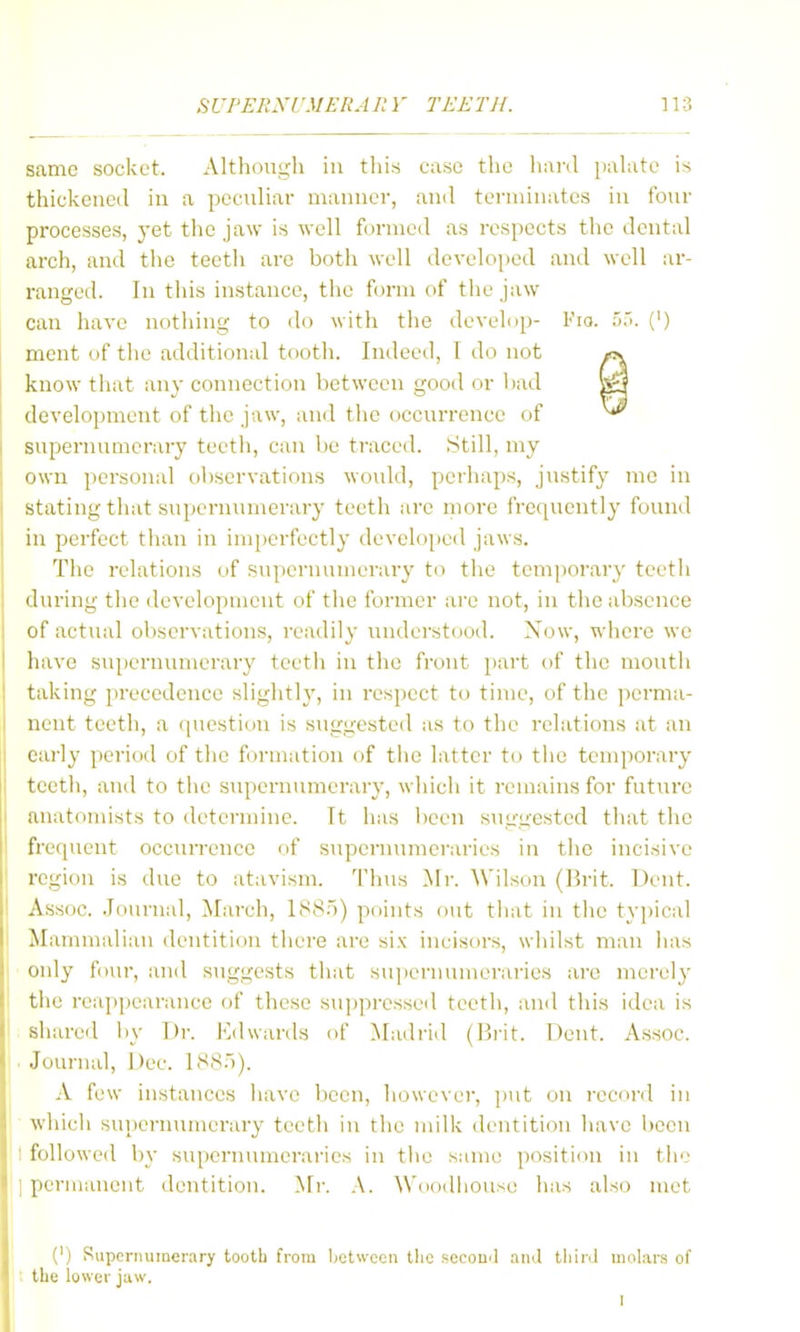 Scame socket. Although in this case the hiird pahite is thickened in a peculiar manner, ami terminates in four processes, yet the jaw is well formed as respects the dental arch, and the teeth are both well developed and well ar- ranged. In this instance, the form of tlie jaw can have nothing to do with the develop- Fio. '>'<. (') ment of tlie additional tooth. Indeed, T do not know tliat any connection between good or bad development of the jaw, and the occurrence of supernumerary teeth, can be traced. Still, my own pcrson;d observations would, perhaps, justify nic in stating that supernumerary teeth are more frequently found in perfect tlian in imperfectly developeil jaws. The relations of supernumerary to the temporary teeth during the development of the former are not, in the absence of actual ol)servations, readily understood. Now, where we have supernumerary teeth in the front part of the mouth taking precedence slightly, in respect to time, of the ])crma- nent teeth, a C[uestion is suggested as to the relations at an early period of the formation of tlic latter to tlie temporary teeth, and to tlie supernumerary, wliich it remains for future anatomists to determine. It has been suggested that tlie frequent occurrence of supernumeraries in the incisive region is due to atavism. Thtis Mr. AVilson (Brit. Dent. Assoc. .Tdurnal, March, 1<S8.)) points out tliat in tlic typical Mammalian dentition tliere are six incisors, whilst man has only four, and stiggests tiiat supernumeraries are merely tlie rea]>pearance of these suppressed teeth, and this idea is siiared by Dr. Kdwards of Madrid (Brit. Dent. Assoc. Journal, i)ec. L^S;')). A few instances have boon, howevei', put on record in wliich supernumerary teeth in the milk dentition have been followed by supcrmuneraries in the same position in the [lennanent dentition, ^fr. A. Woodiioust; has also met (') Supernumerary tooth from Ijetwcen the secouil ami tliirJ molars of the lower juw. I