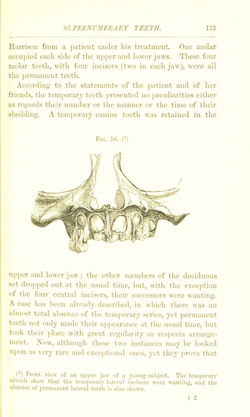 Hiirrisou from a ])aticnt muler his treatment. One molar occu])ied each side of the iijjper and k>\ver jaws. Tliese four molar tectli, with fonr incisors (two in each jaw), were all the jjcrnmnent teeth. Accordiny to the statements of the ]>atient and of her friends, the temjiorary tcetli ])rescnted no i)eculiarities eitlier as repirds their mmiber or tiic manner or the time of their shedding. A temporary canine tooth was retained in the Fu;. 56. (') II]iper and lower jaw ; the other members of the deciduous set dr(ij)ped out at the usual time, but, with tlie exce])tion of tiie four central incisors, their successors were wanting. A case has been already described, in which tlicre was an almost total absence of tlie tem^jorary series, yet permanent teeth not only made their a])])earance at tlie usual time, but took tlieir place with great regularity as resjiects arrange- ment. Now, although these two instances may be looked u]ion as very rare and e.xce]itioual ones, yet they prove that (') Front view n[ an upper jaw of u young siilijcct. Tlie tcniiwrnrv alveoli sliow that tlie teniijoraiy lateral incisors were wanting, and the absence of licrniaucut lateral teeth is also .shown. I 2