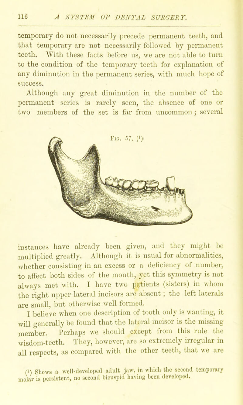 temporary do not necessarily precede permanent teeth, and that temporary are not necessarily followed by permanent teeth. With these facts before us, we are not able to tuni to the condition of the temporary teeth for exj^lanation of any diminution in the jjermanent series, with much hope of success. Although any great diminution in the number of the permanent series is rarely seen, the absence of one or two members of the set is far from uncommon; several iustances have already been given, and tliey might be multiplied greatly. Altliougli it is usual for abnormalities, whether consisting in an excess or a deficiency of number, to affect both sides of the mouth, yet this symmetry is not always met with. I have two patients (sisters) in whom the right upper lateral incisors are absent ; the left laterals are small, but otlierwise well formed. I believe when one description of tooth only is wanting, it will generally be found that the lateral incisor is the missing member. Perhaps we should except from this rule the wisdom-teeth. They, however, arc so extremely irregular in all respects, as compared with the other teeth, that we are (1) Shows a well-devcloiied adidt jaw. in whicli the second temporary molar is persistent, no second bicuspid having been developed.