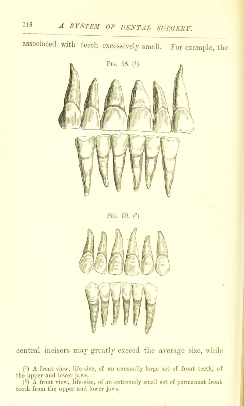 associated with teeth excessively small. For example, the central incisors may greatly exceed the average size, while (') A front view, life-size, of an umisiiall}- large set of front teeth, of the upper and lower jaws. (-) A front view, life-size, of an extremely small set of permanent front teeth from the upper and lower jaws.