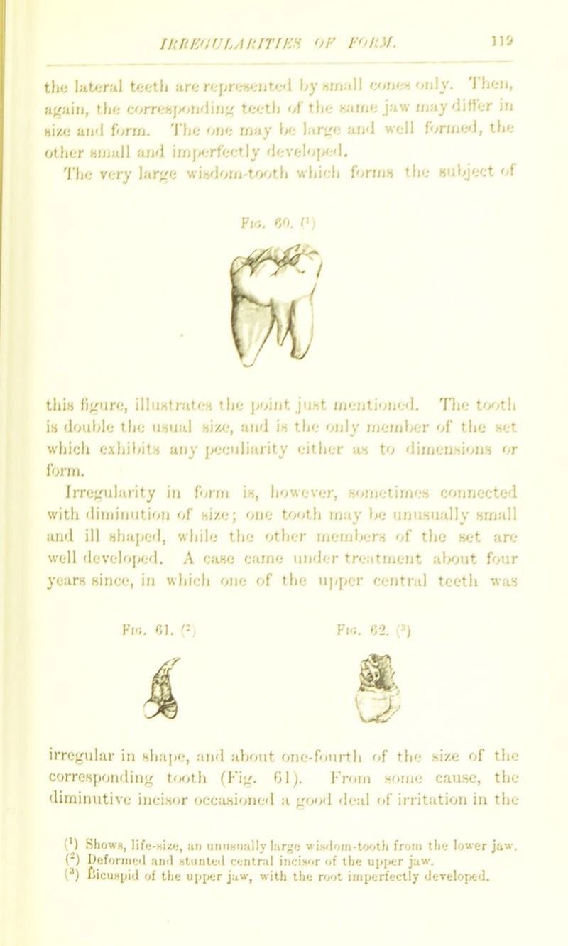 JUREdUI.AIilTIEH OF I'Oli.U. the lateral teeth are rfprf:»eiitx'<l by wnall cjmt^a only. Then, again, the (:')m:H\><ju<Uti'^ teeth of the wirne jaw luay ditter in Hize aii'i form. 'ihe one rnay \x: large aii'l well fonncJ, the otiier Hinall and inijA.-rfeetly develo{X;d. 'i'he very large witjfJoni-tcKjth which forrn« the Bubject of Vi'i. 60. (') tliiH figure, illii«trateH the point jiiht njentioned. Tlie to^jth is double the UKual «ize, and i« the only member of the set which exhibits any j>ecnliarity either as to dimensions or form. Irregularity in form is, however, sometimes connected with diminution of size; one t^joth may be unusually small and ill shaped, while the other memljers of the set are well developed. A case came under treatment alK»ut four years since, in wliich one of the u|(i>er central teeth was Fk;. Cj2. (■') irregular in shape, and about one-fourth of the size of the corresponding tooth (Fig. 01). From s'lme cause, the diminutive incisor occasioned a good deal of irritation in the (') Shows, lif<;-Ki/.';, an unimiially lar^e wiwiom-tooth from the lower jaw. (j') Dcfornieil and ntunte'l central incisor of the upiicr jaw. (^) fiicuHpid of the upijer jaw, with the root imperfectly dcTelopeJ.