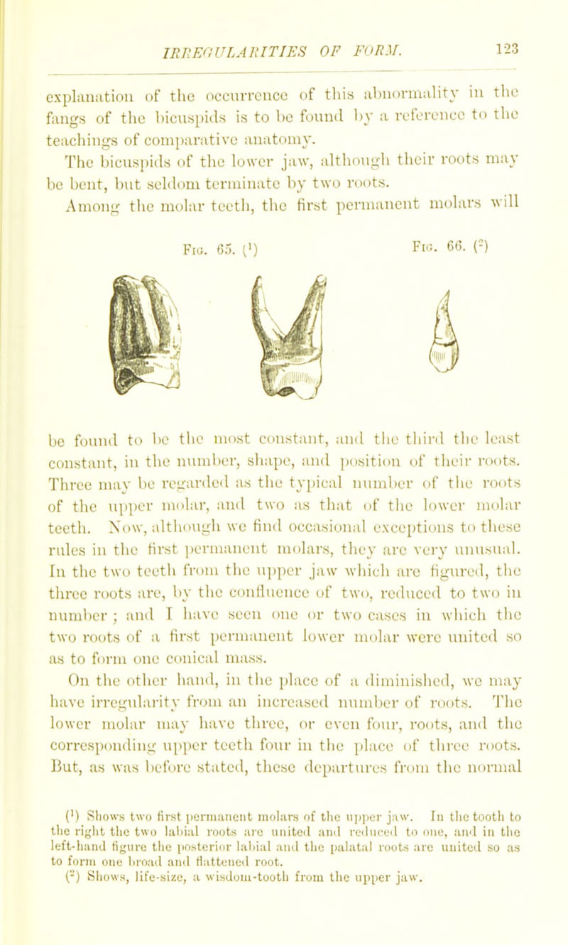 explanation of the occurrence of this almormality in the fangs of the bicuspids is to be found by a reference to the teachings of comparative anatomy. The bicuspids of the lower jaw, althoui^h their roots may be bent, but seldom terminate by two roots. Among tlio molar teeth, the first permanent molars will Fi«. 65. (') Fir.. 6C. (-) be found to be the most constant, and the tliird tiie least constant, in the number, sliape, and position of tlieir r(»ots. Three may be regarded as the typical number of tiie roots of the upper molar, and two as that of the lower molar teetii. Now, altiiough we find occasional exceptions to these rules in the first ])ermaneut molars, they are very unusual. In the two teeth from the upper jaw which are figured, the three roots are, by the confluence of two, reduced to two in number ; and I iiave seen one or two cases in wluch the two roots of a first permanent lower molar were united so as to form one conical mass. On the other hand, in the place of a diminished, we ni;iy have irregidarity from an increased number of roots. 'ihe lower molar may have three, or even four, roots, and the corresponding upper teeth four in the ]»lace of three roots. But, as was before stated, these departures from the normal (') Shows two first iieiTiianent molara of the upper jaw. In the tooth to the right the two hiliial roots are united and reduced to one, and in the left-hand figure tiio postericjr laljial and the pahital roots are united so as to form one broad and flattened root. ('■') Shows, life-size, a wisdom-tooth from the upper jaw.